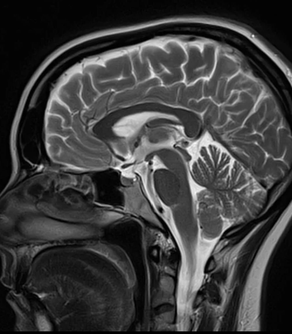 sagittal MRI of the brain (midline)