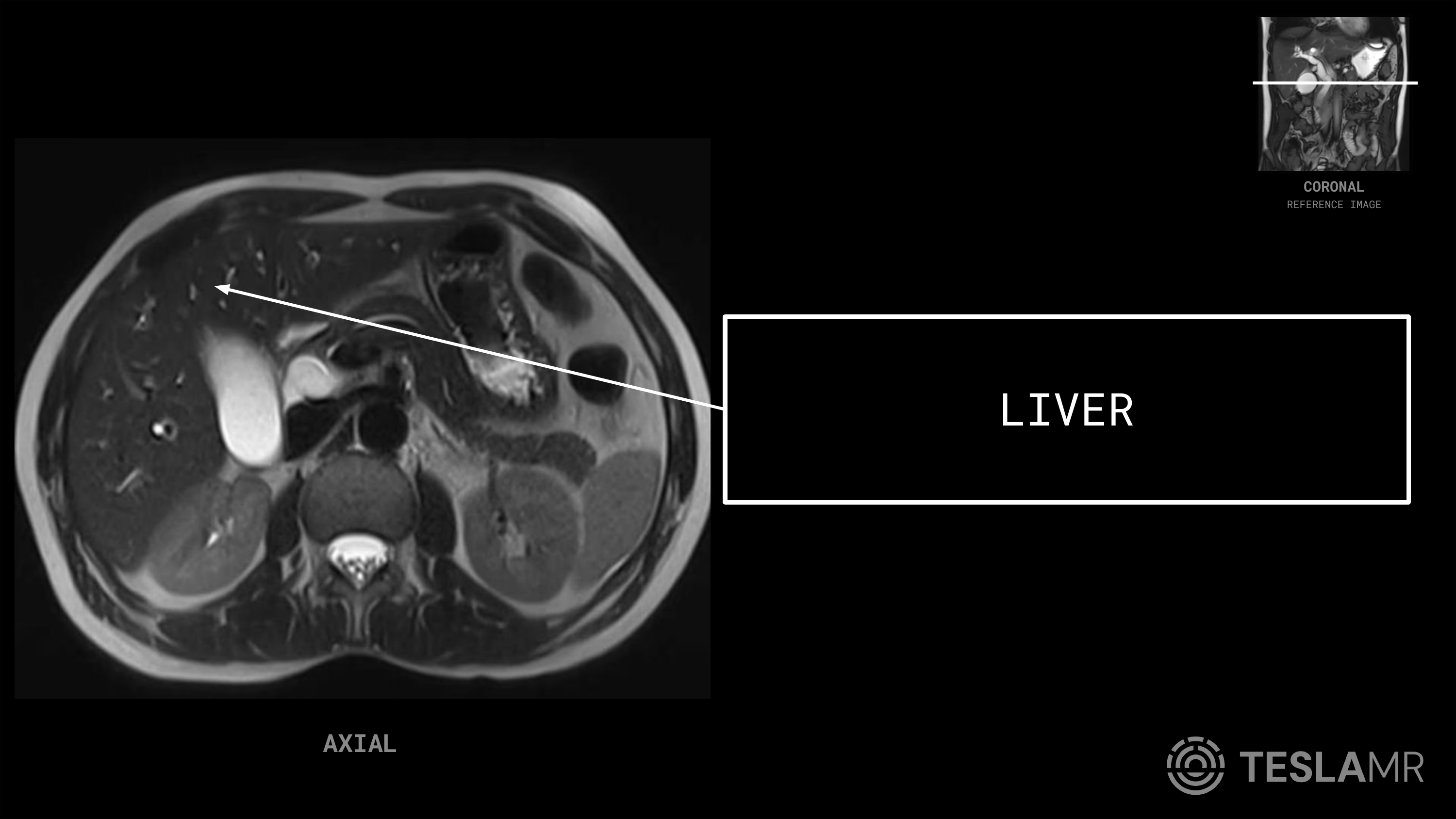 Liver labeled on a Abdomen MRI (Axial · Coronal)