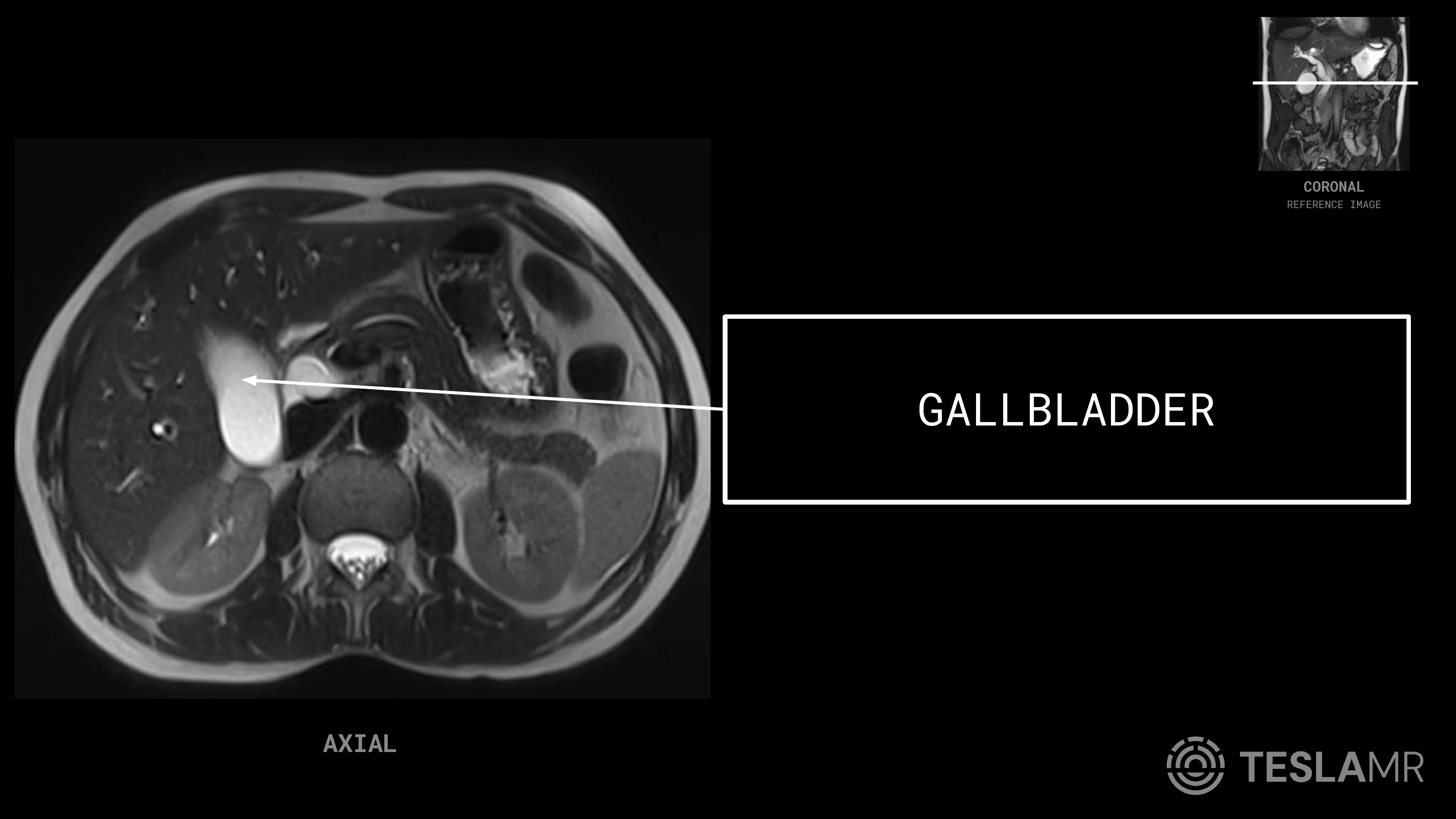 Gallbladder labeled on a Abdomen MRI (Axial · Coronal)
