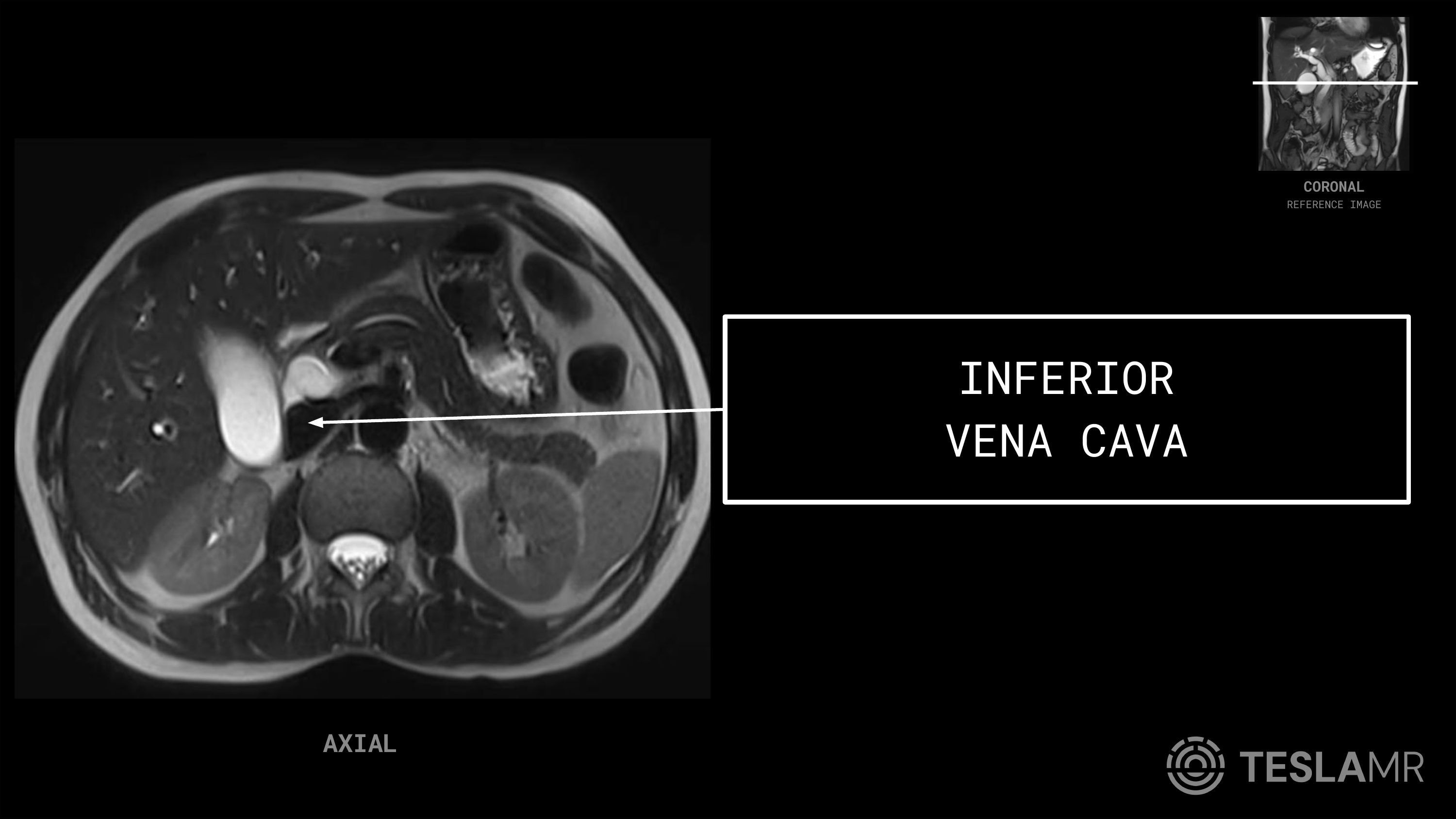 Inferior Vena Cava labeled on a Abdomen MRI (Axial · Coronal)