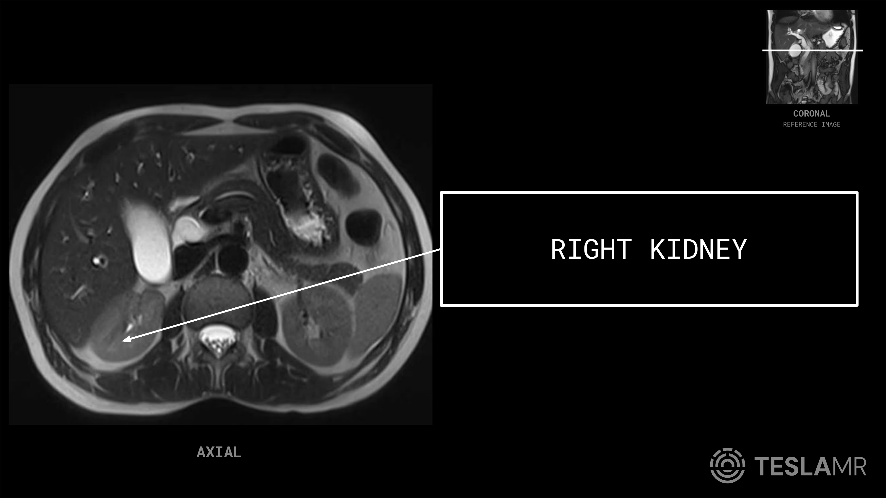 Right Kidney labeled on a Abdomen MRI (Axial)