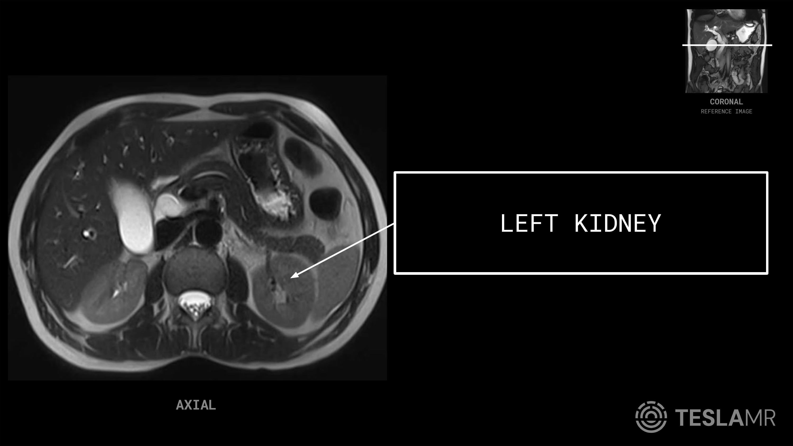 Left Kidney labeled on a Abdomen MRI (Axial)
