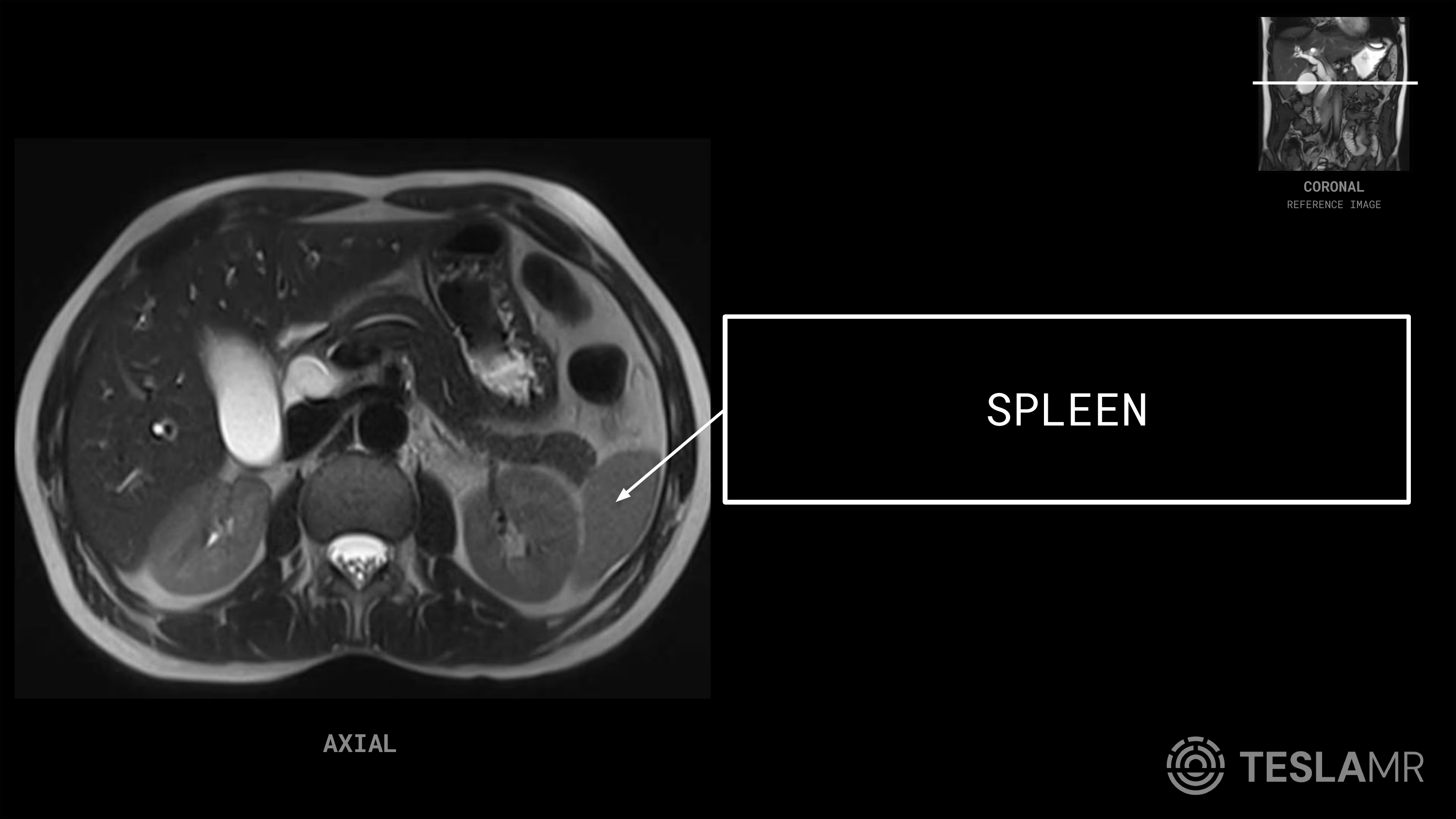 Spleen labeled on a Abdomen MRI (Axial)