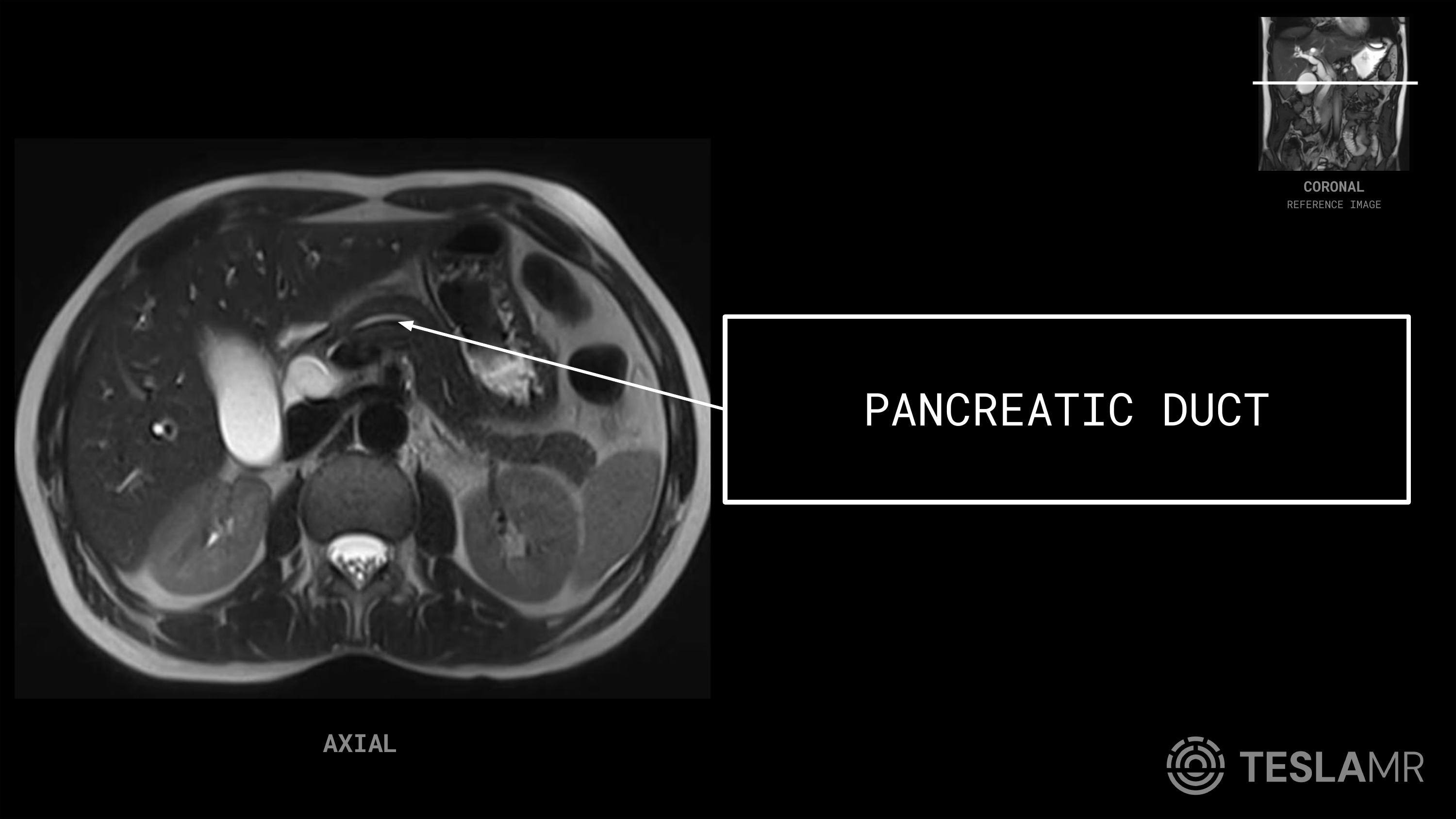 Pancreatic Duct labeled on a Abdomen MRI (Axial)