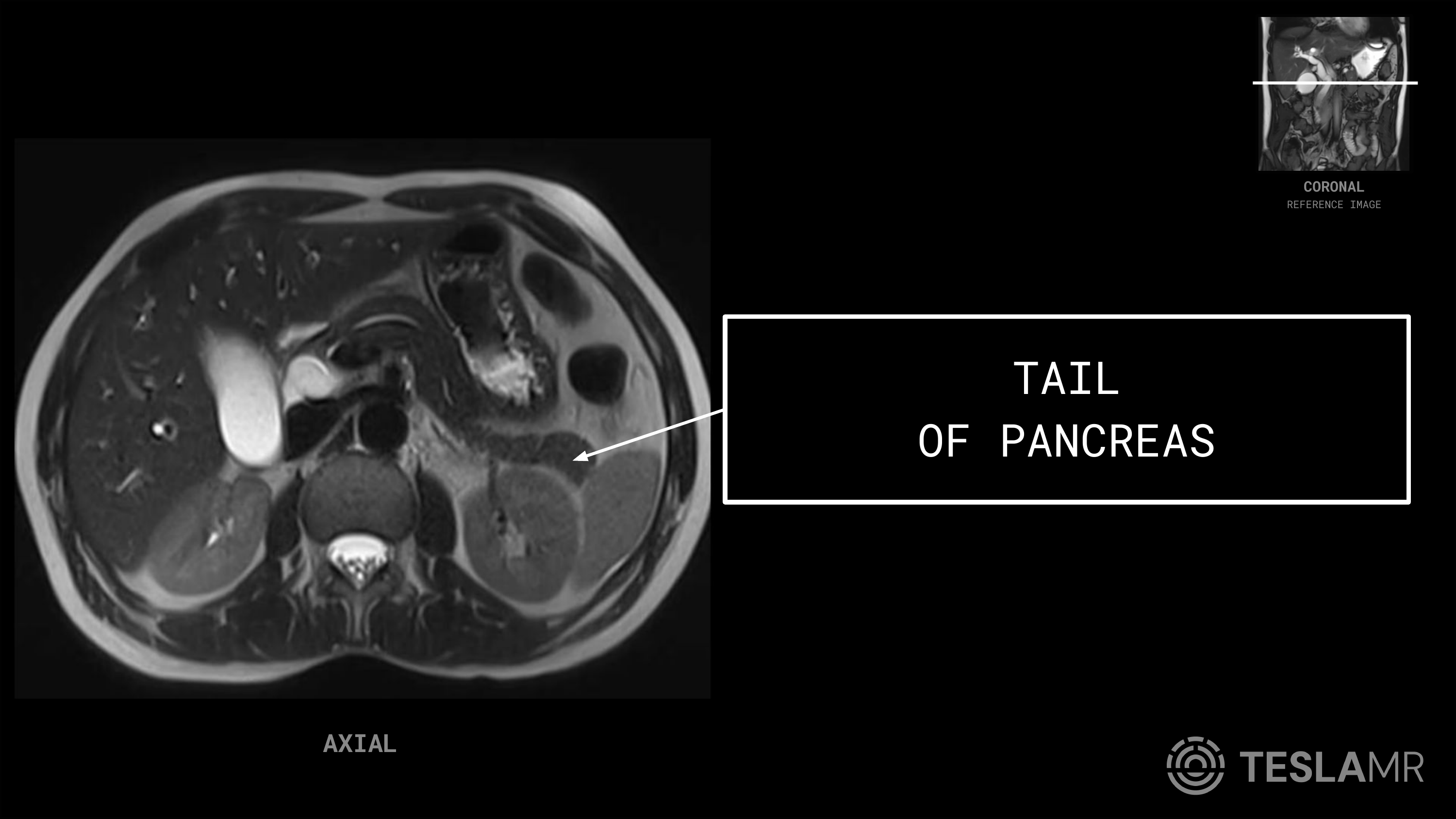 Tail labeled on a Abdomen MRI (Axial)