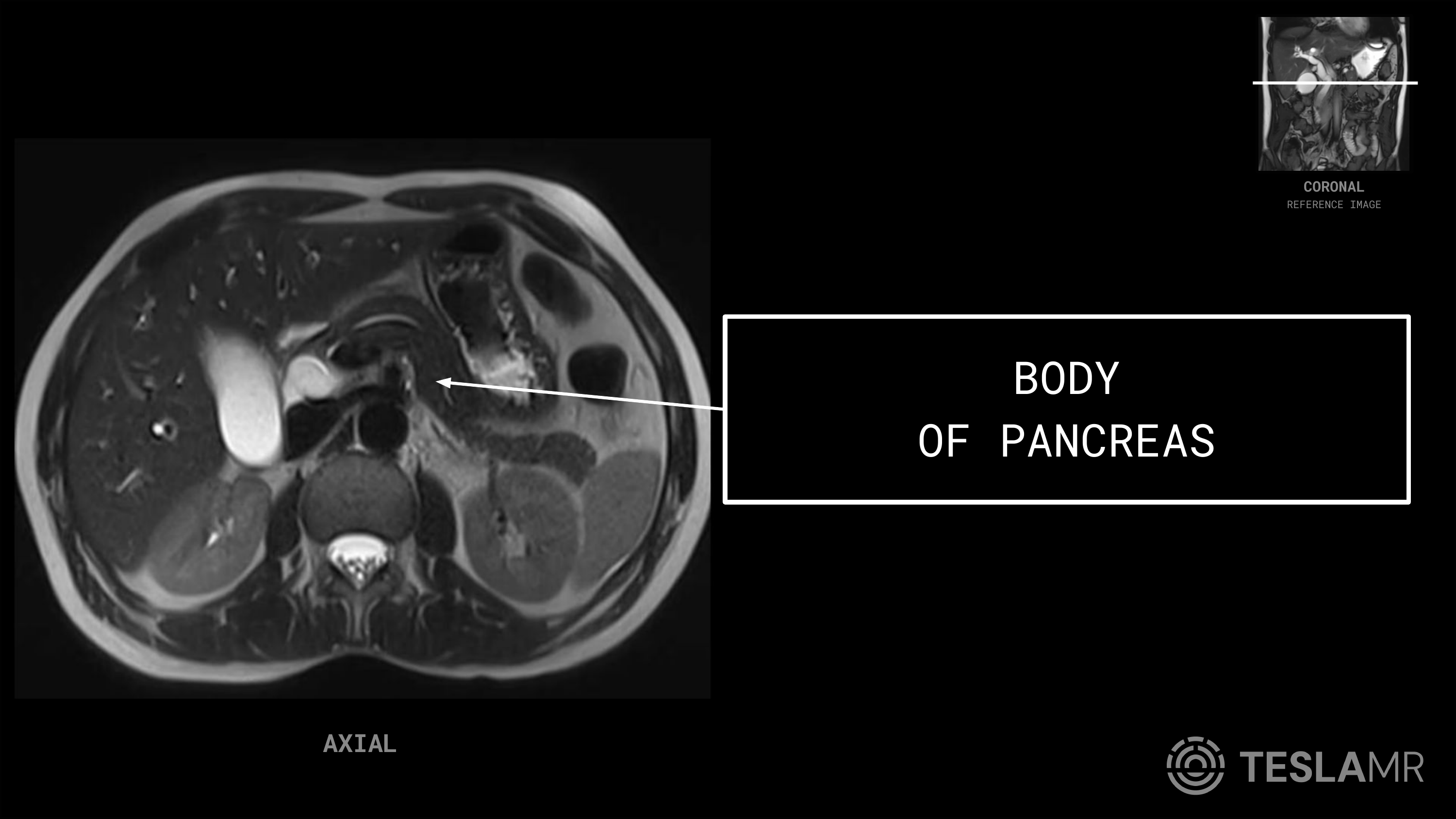 Body labeled on a Abdomen MRI (Axial · Coronal)