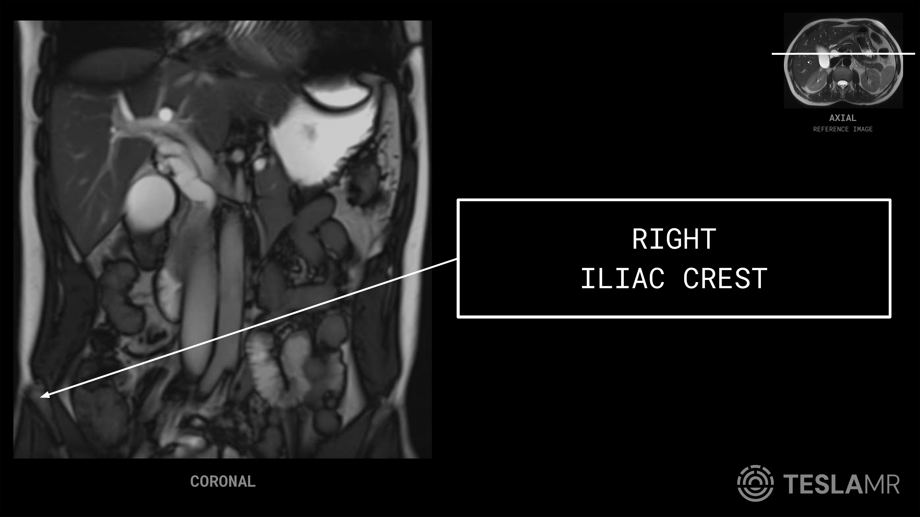 Right Iliac Crest labeled on a Abdomen MRI (Coronal)
