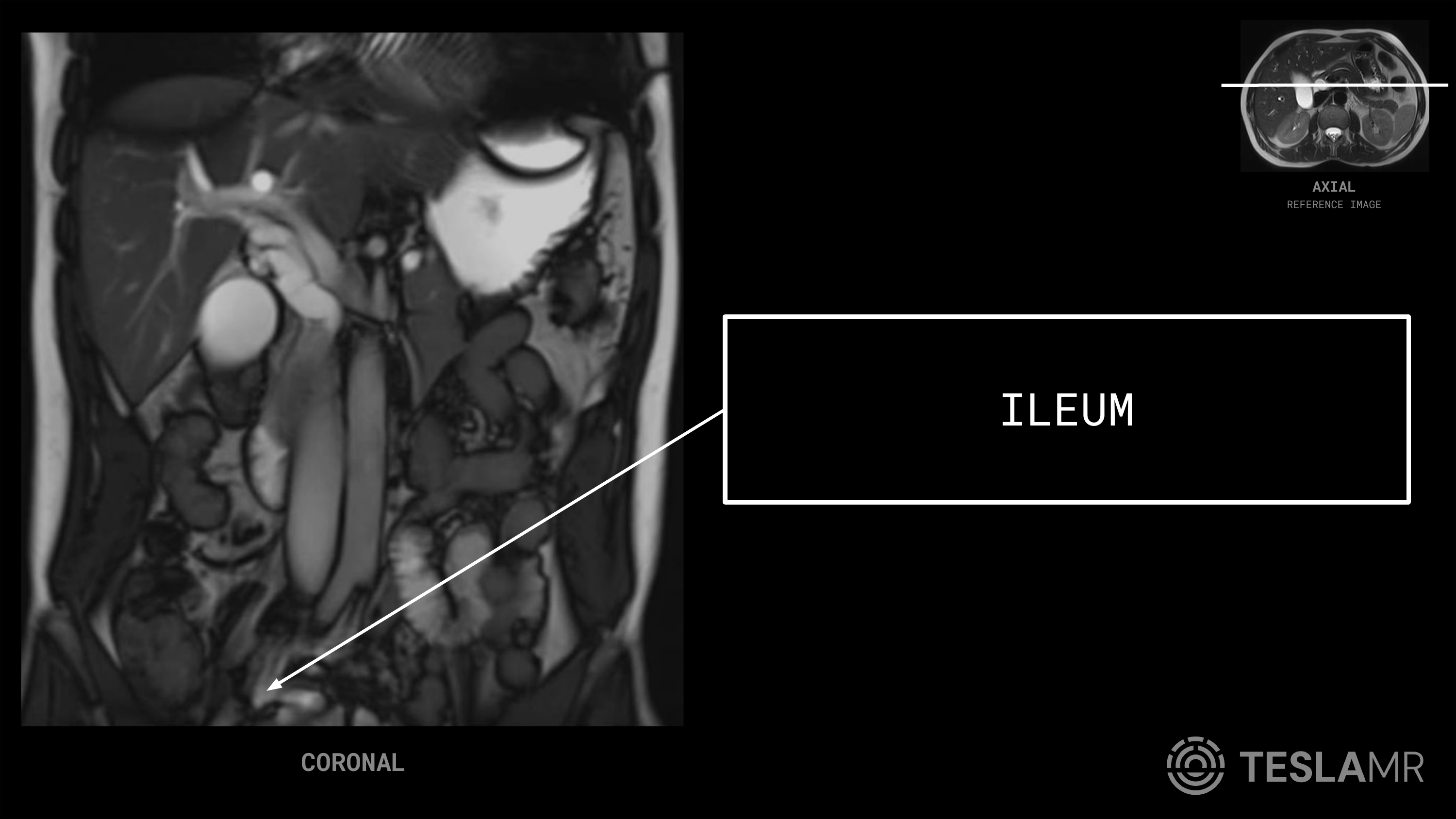 Ileum labeled on a Abdomen MRI (Coronal)