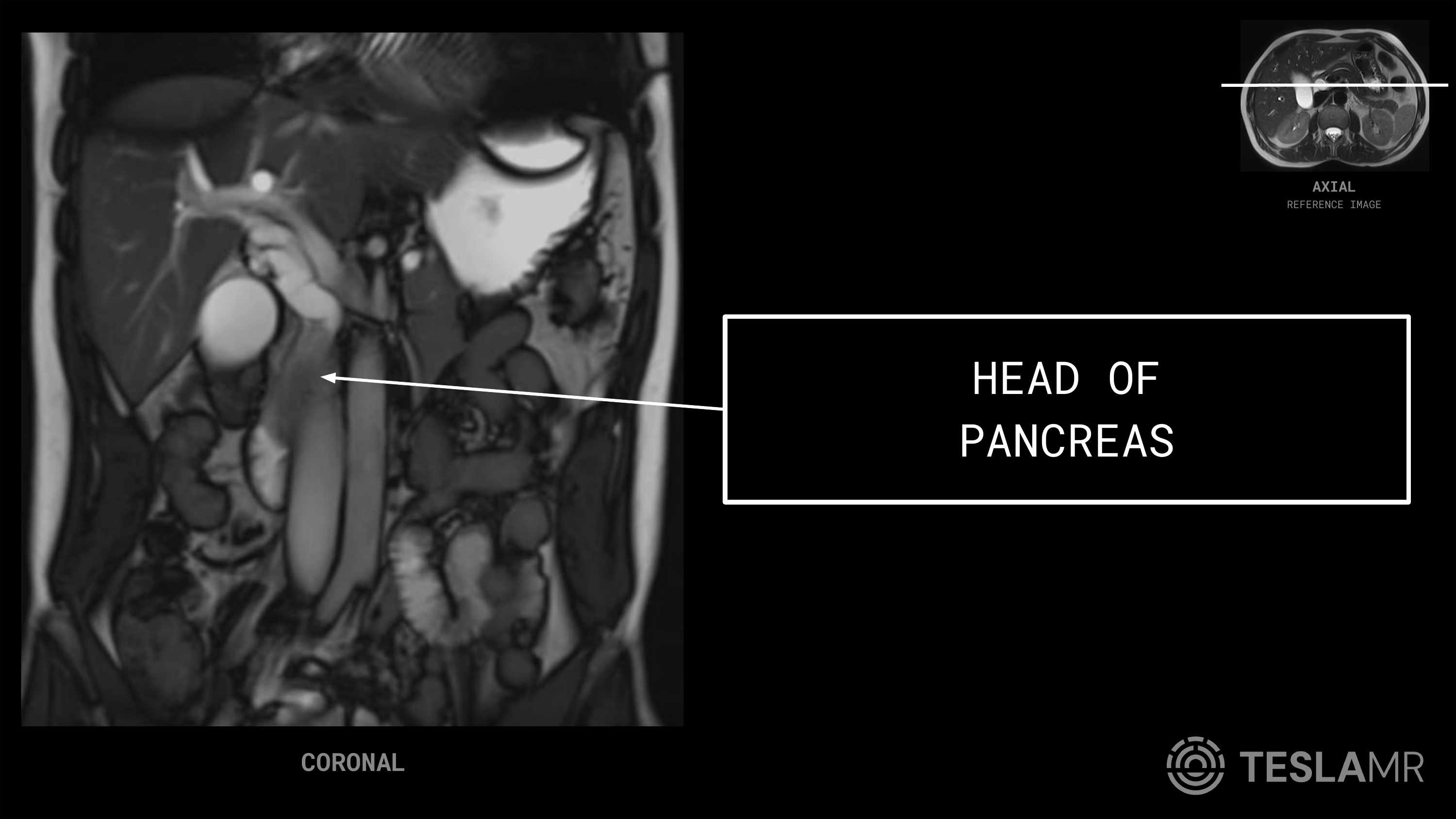 Head of Pancreas labeled on a Abdomen MRI (Coronal)