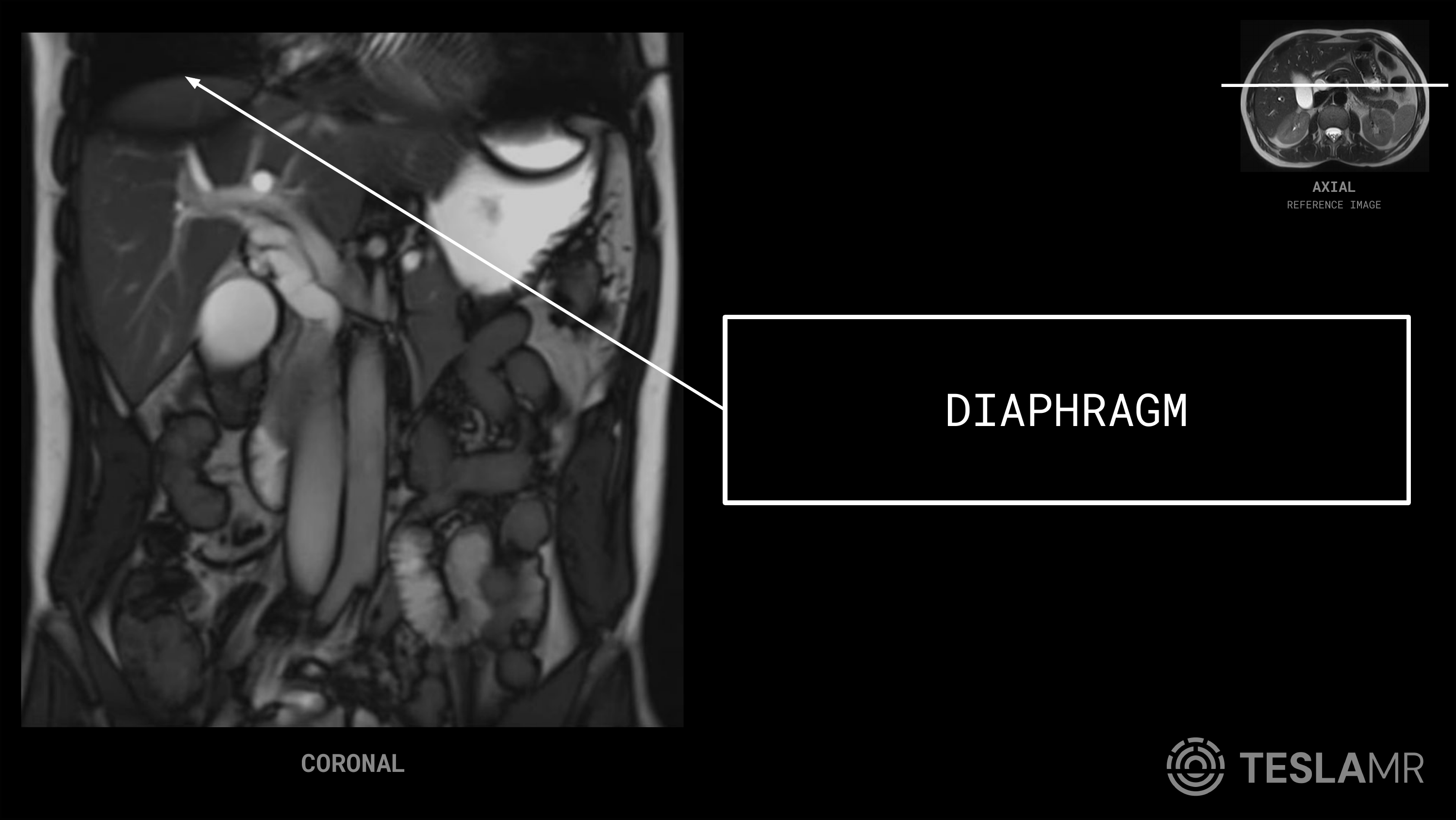 Diaphragm labeled on a Abdomen MRI (Coronal)
