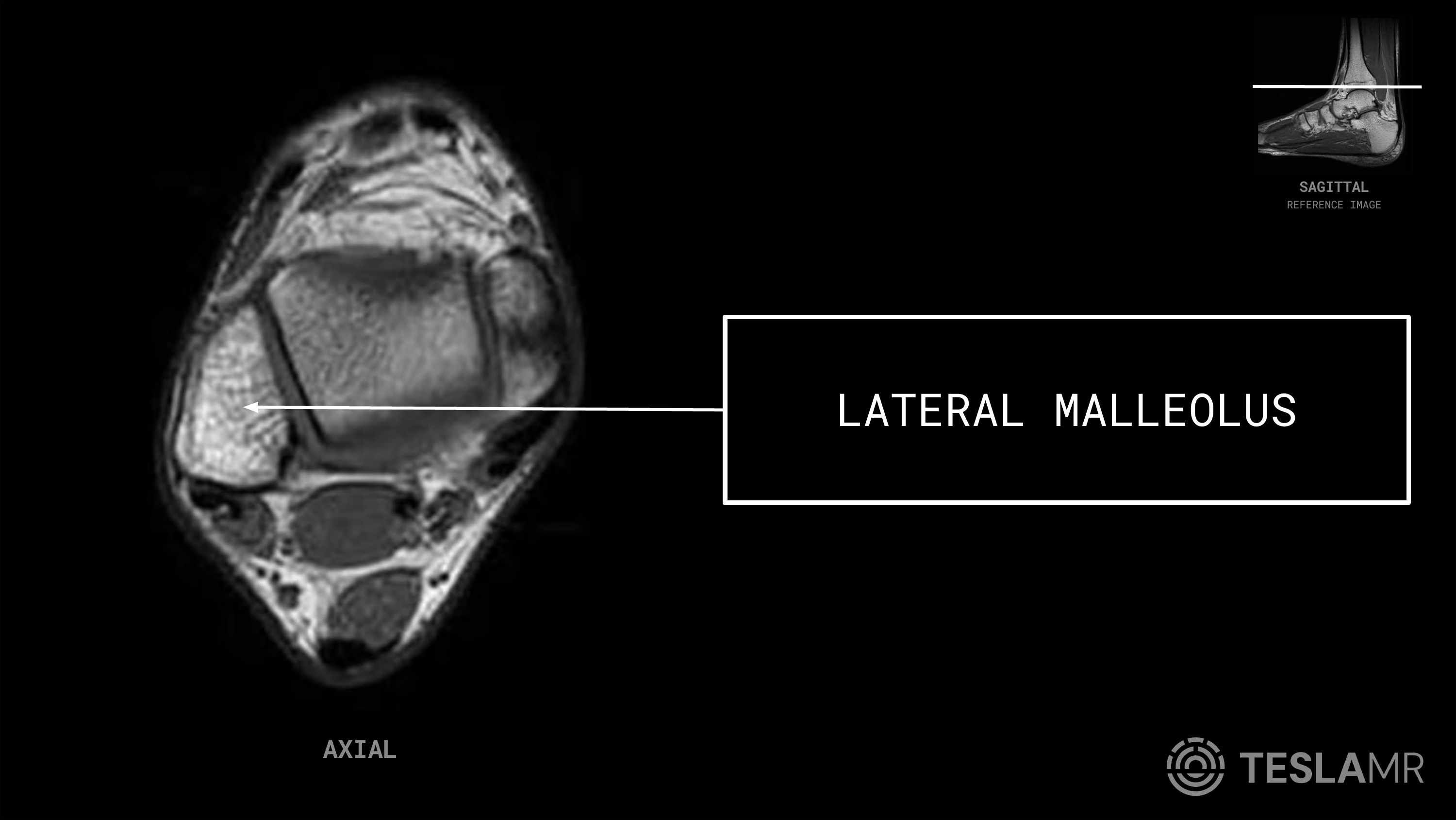 Lateral Malleolus labeled on a Ankle MRI (Axial · Sagittal · Coronal)