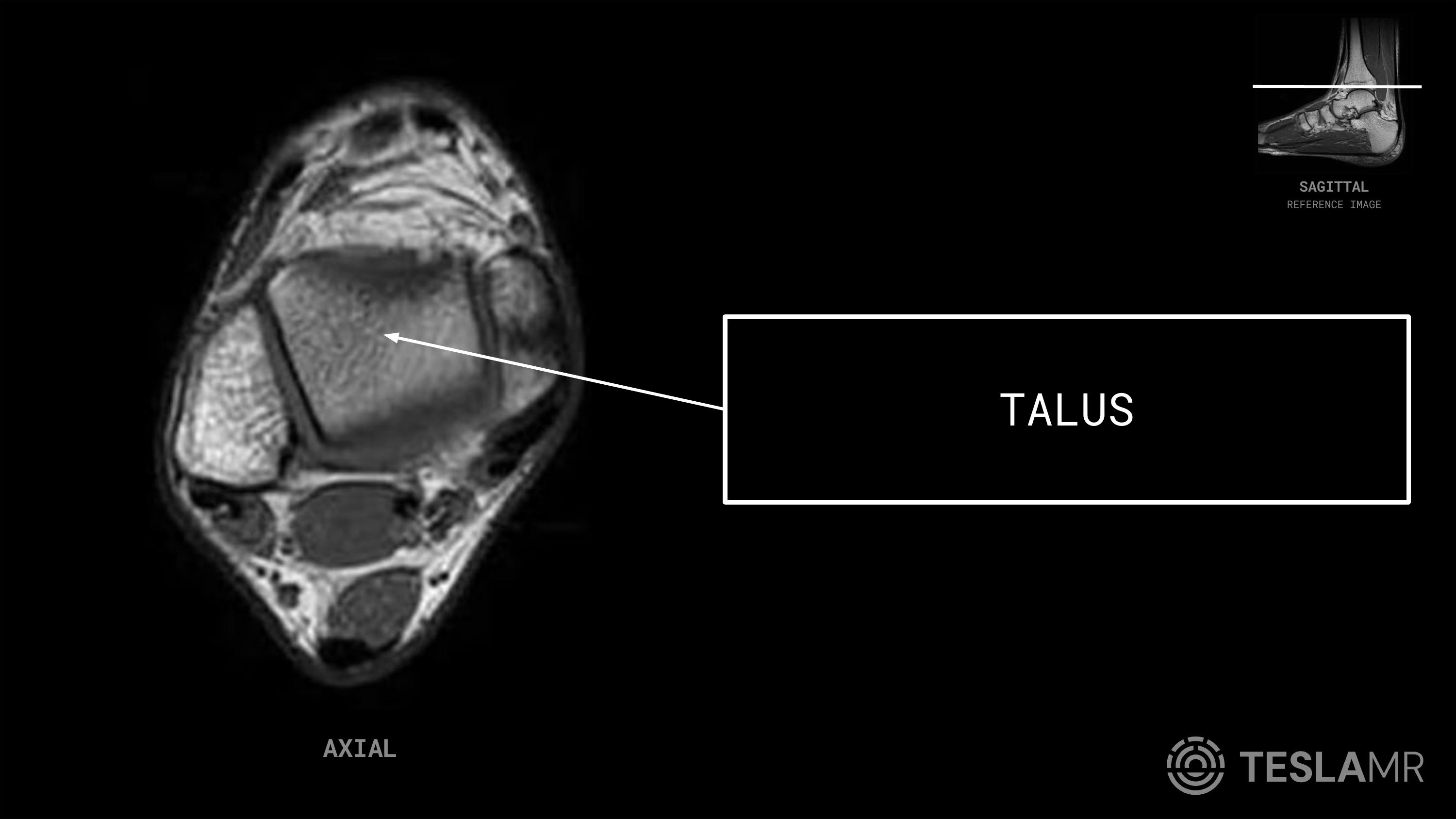 Talus labeled on a Ankle MRI (Axial · Sagittal · Coronal)