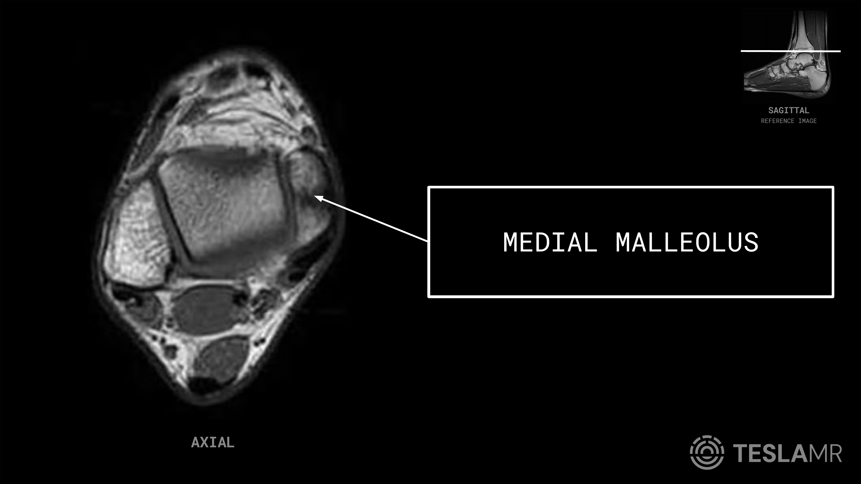Medial Malleolus labeled on a Ankle MRI (Axial · Sagittal · Coronal)