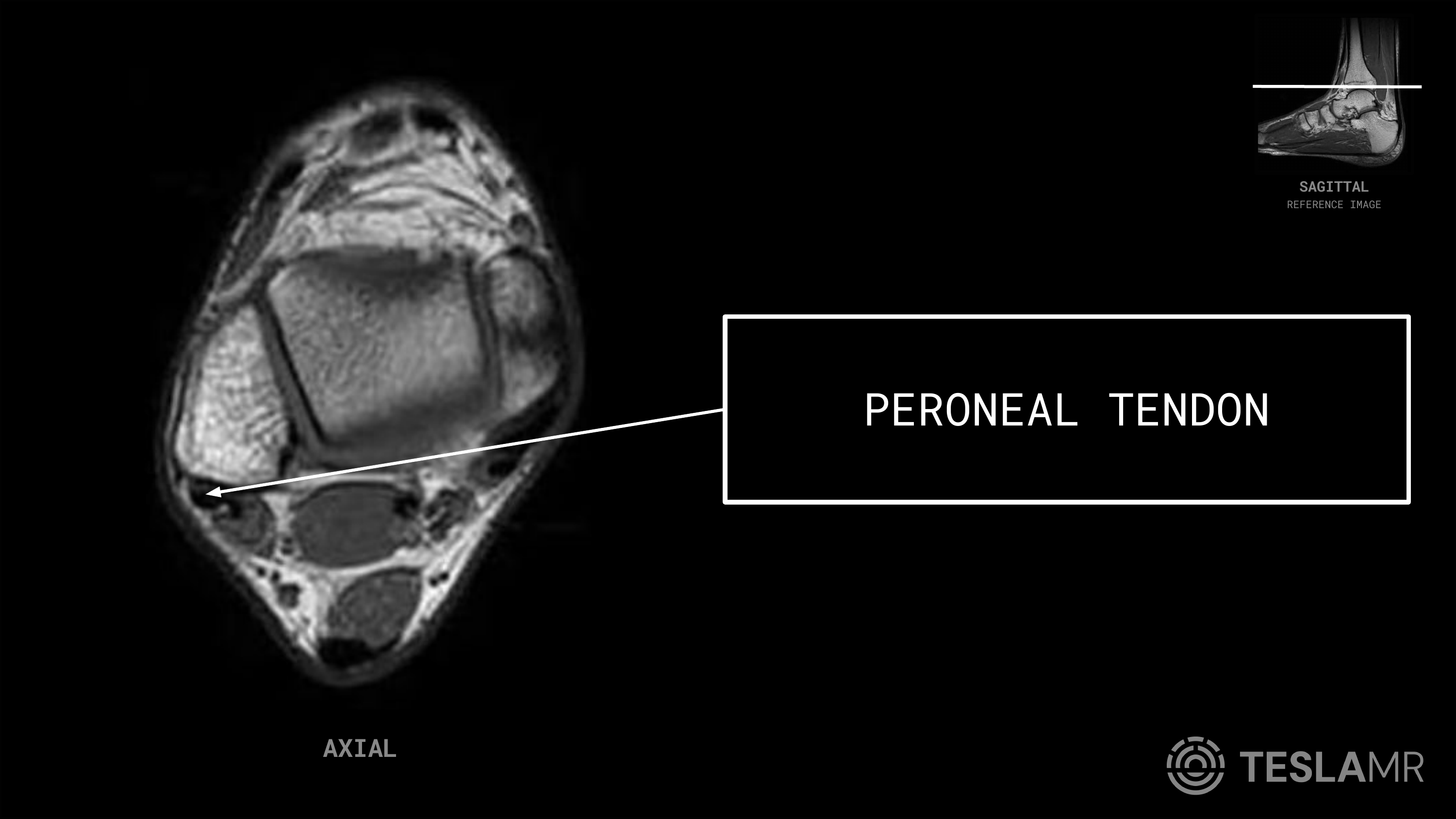 Peroneal Tendon labeled on a Ankle MRI (Axial)