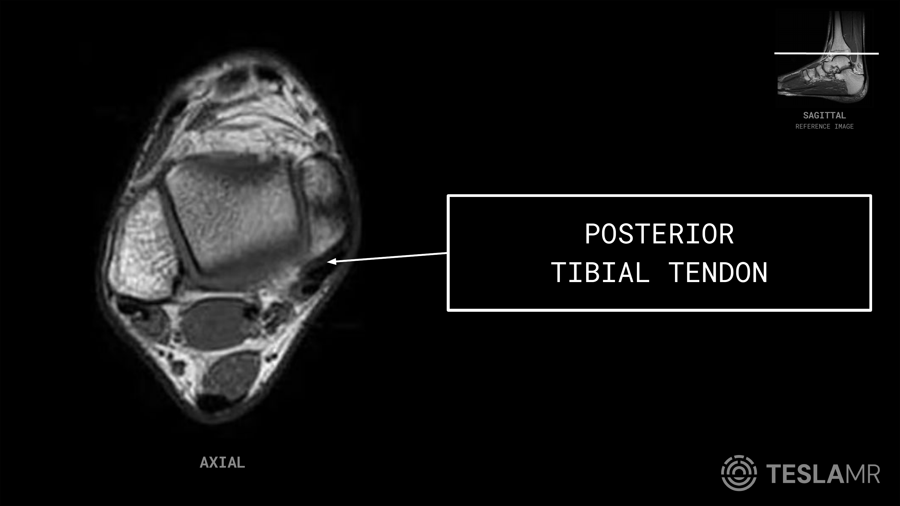 Posterior Tibial Tendon labeled on a Ankle MRI (Axial · Sagittal · Coronal)