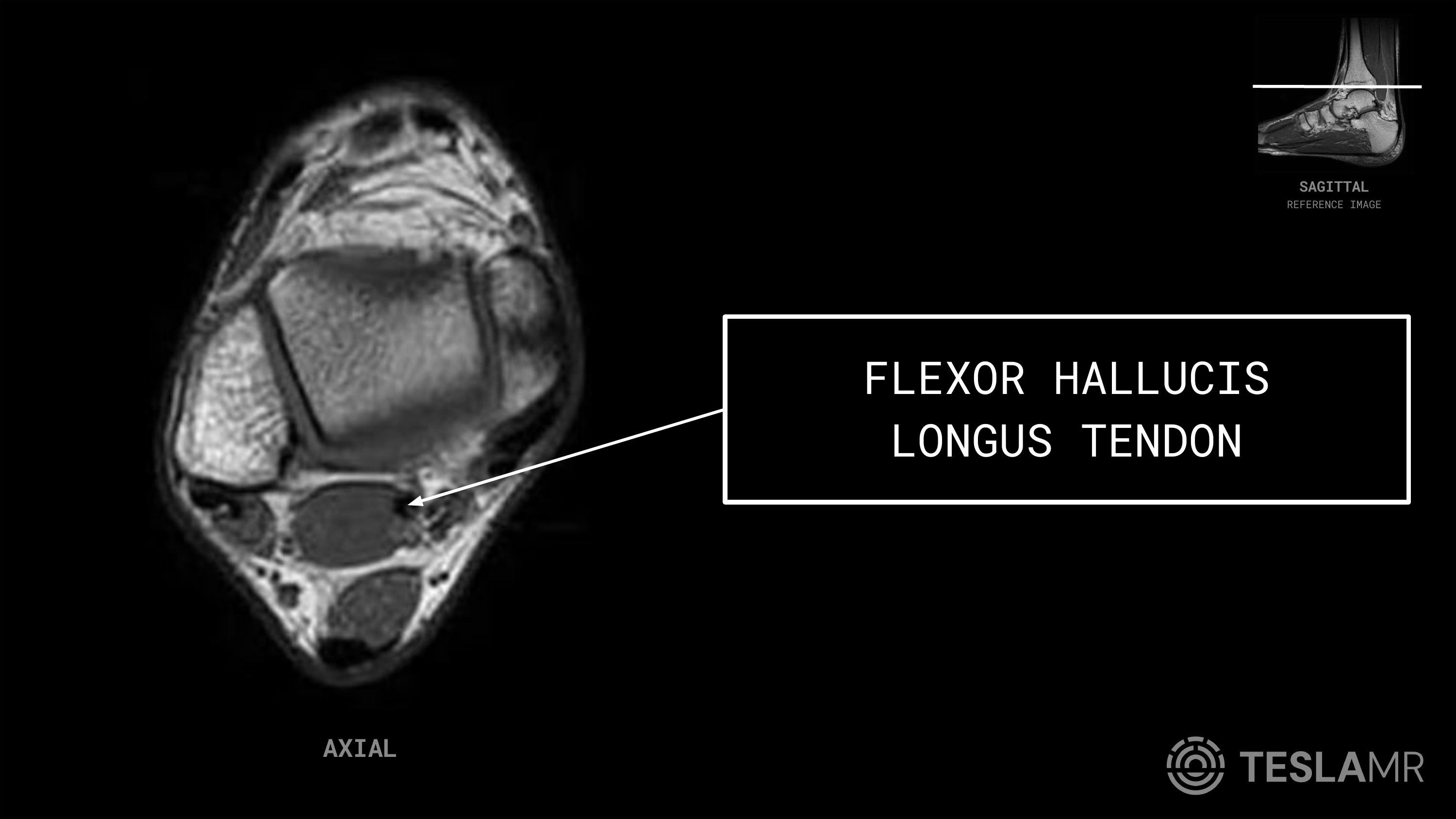 Flexor Hallucis Longus Tendon labeled on a Ankle MRI (Axial)