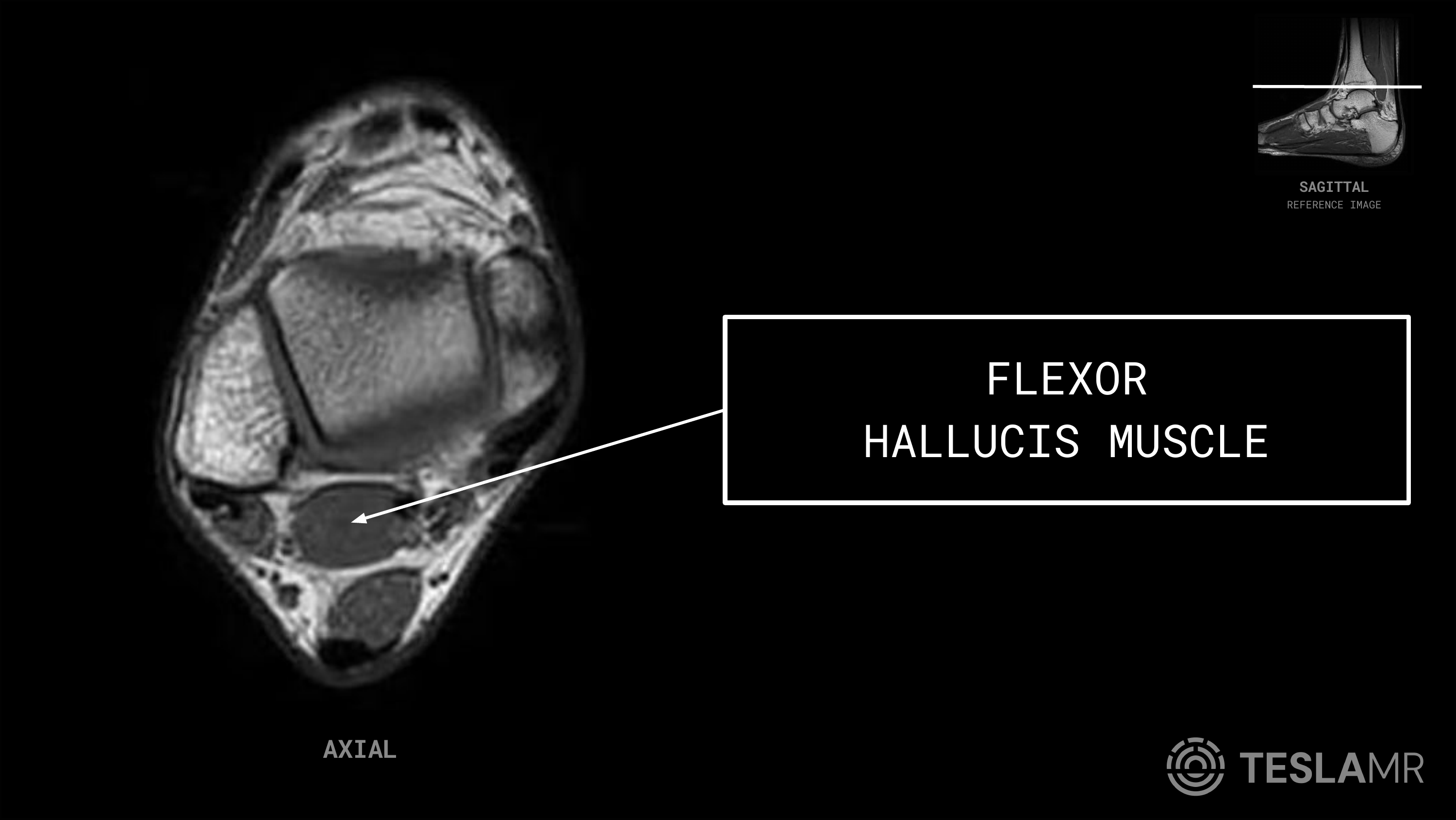 Flexor Hallucis Muscle labeled on a Ankle MRI (Axial)
