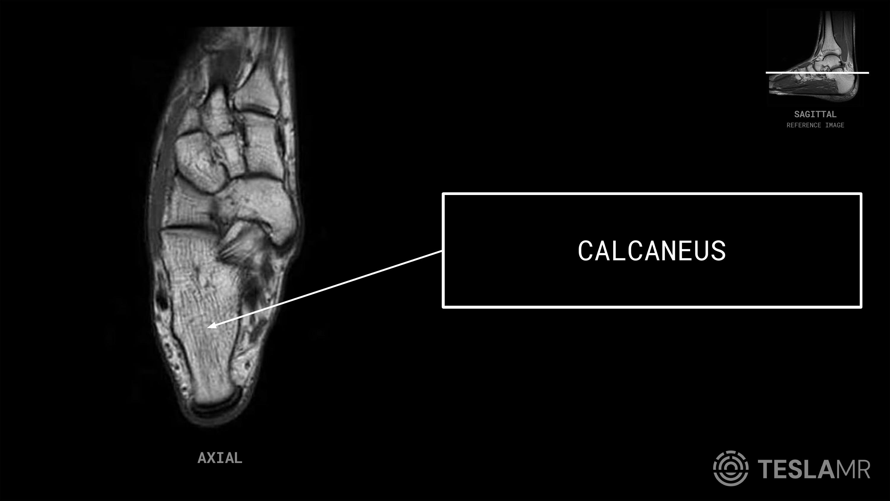 Calcaneus labeled on a Ankle MRI (Axial · Sagittal · Coronal)