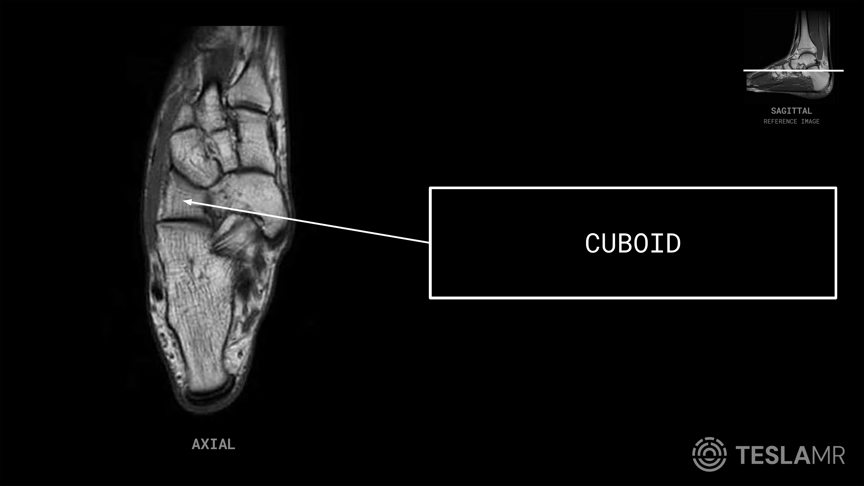 Cuboid labeled on a Ankle MRI (Axial · Sagittal)