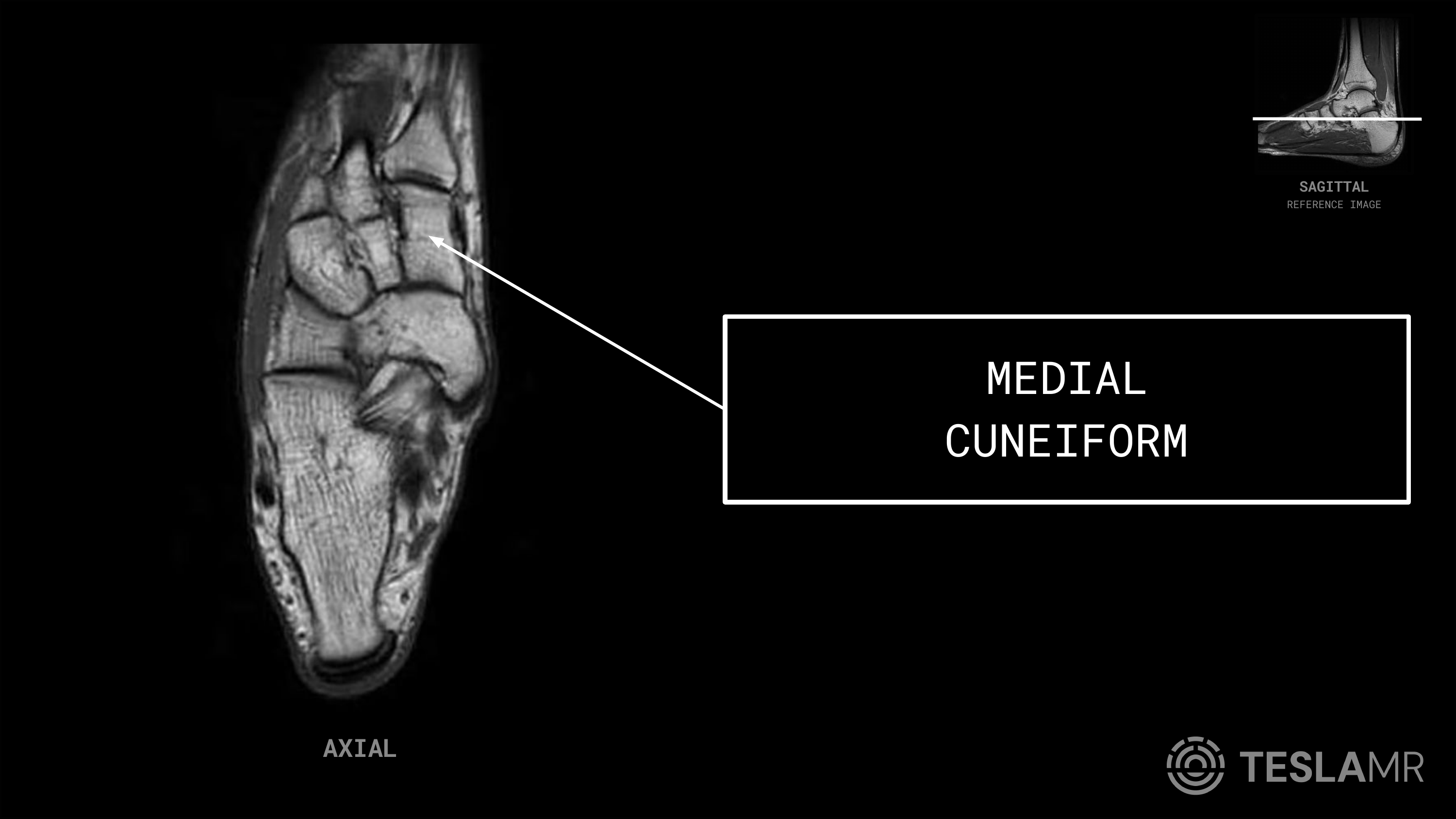 Medial Cuneiform labeled on a Ankle MRI (Axial)