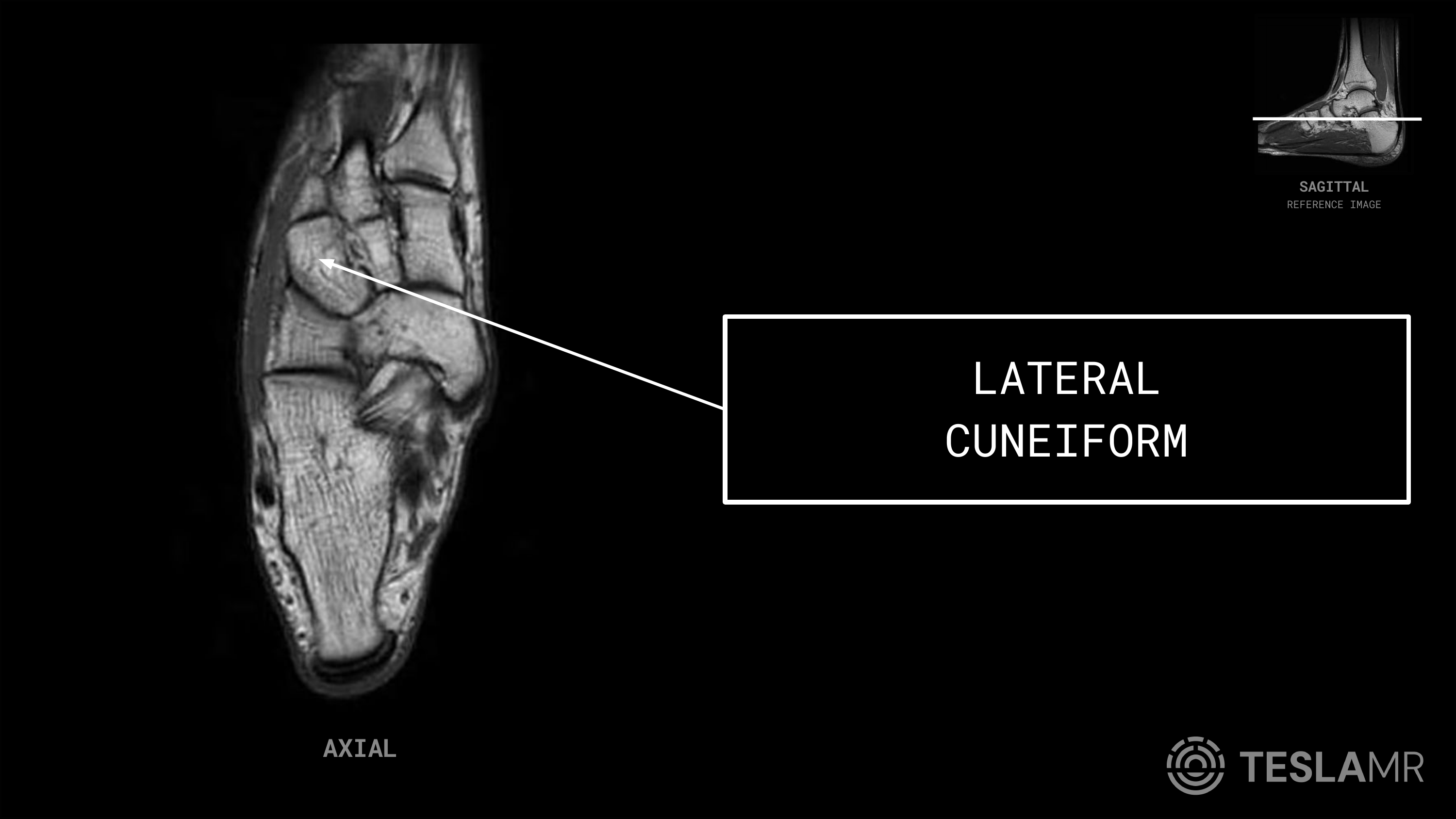 Lateral Cuneiform labeled on a Ankle MRI (Axial)