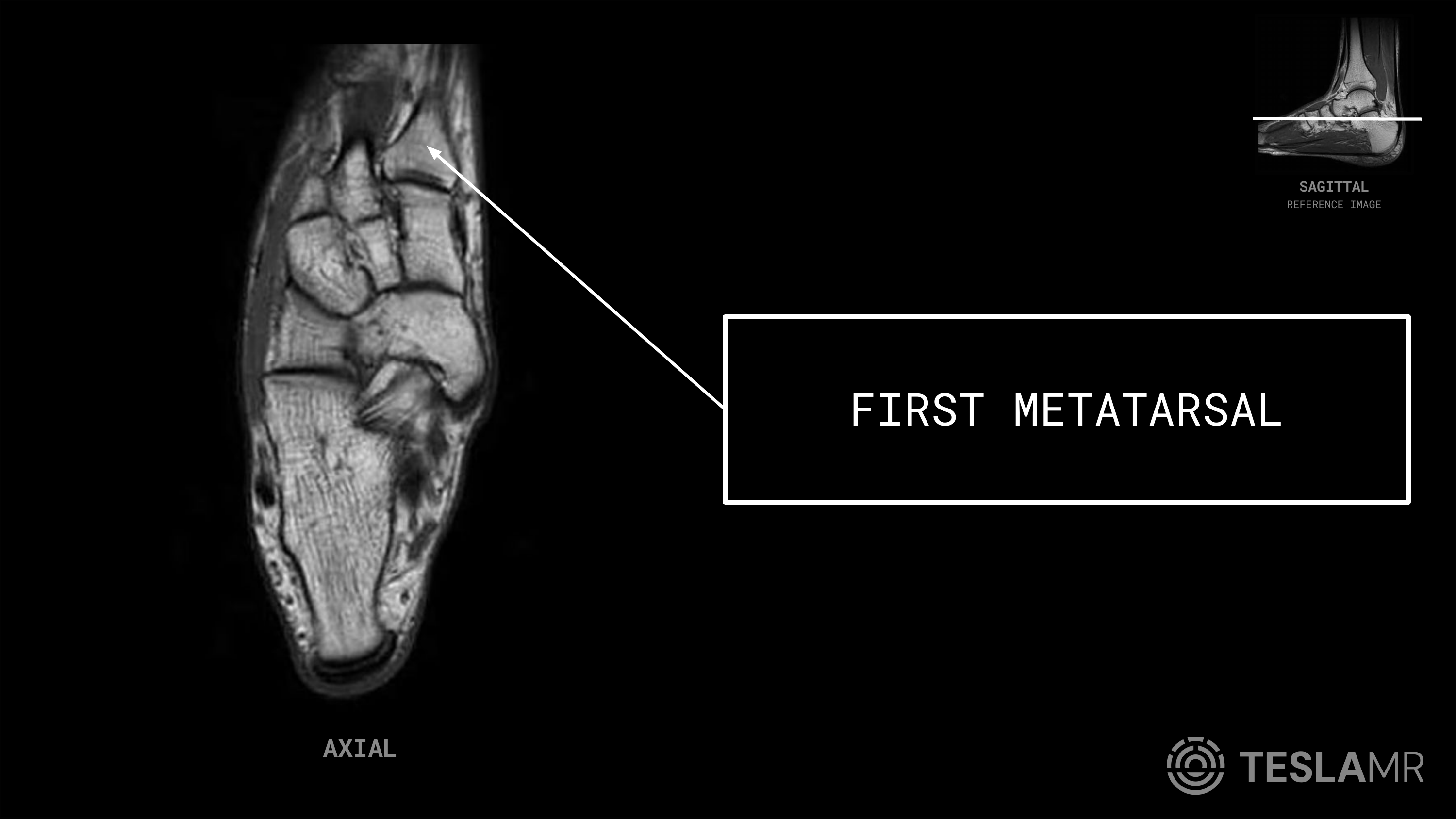 First Metatarsal labeled on a Ankle MRI (Axial)