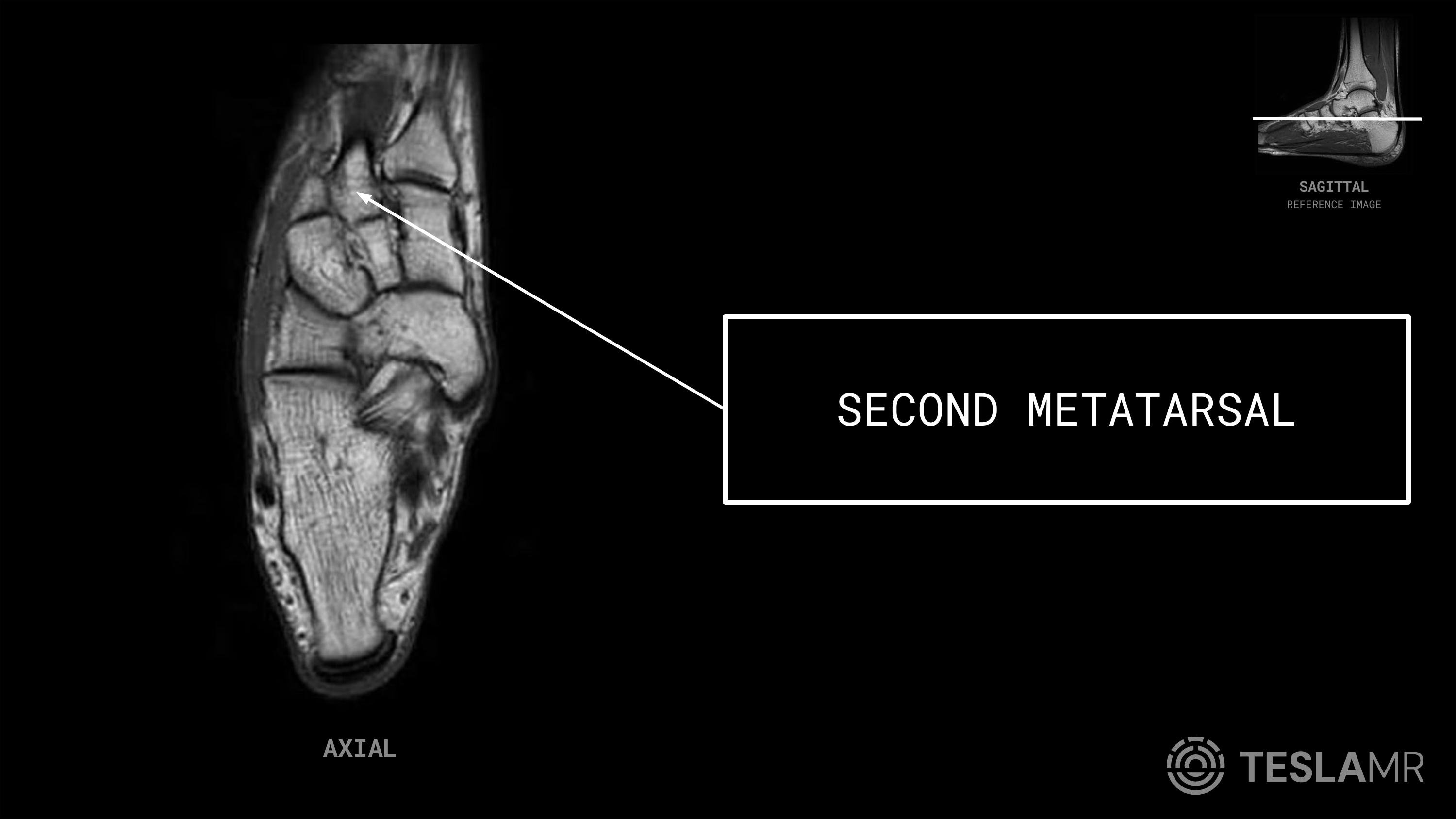 Second Metatarsal labeled on a Ankle MRI (Axial)