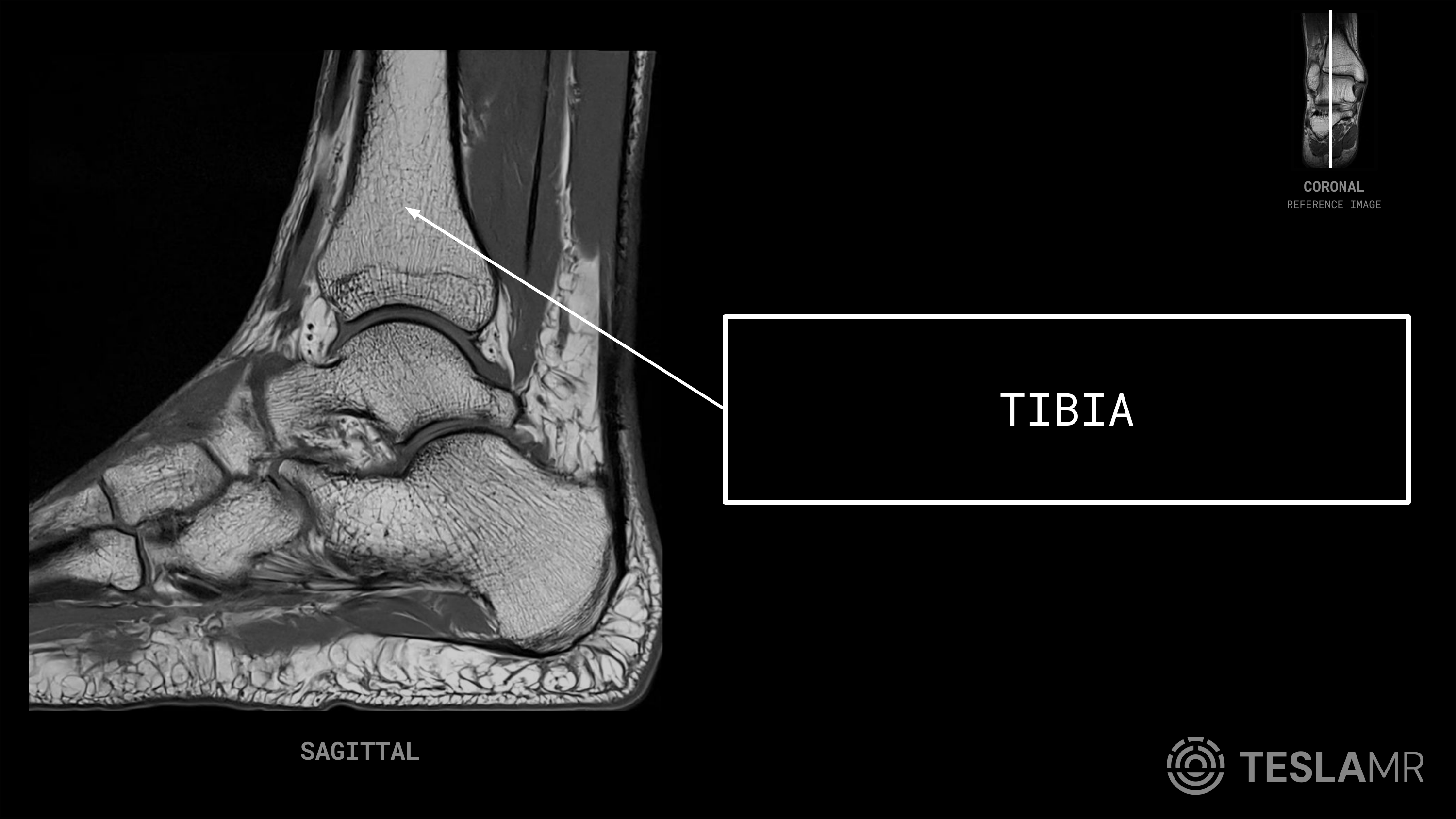 Tibia labeled on a Ankle MRI (Sagittal)