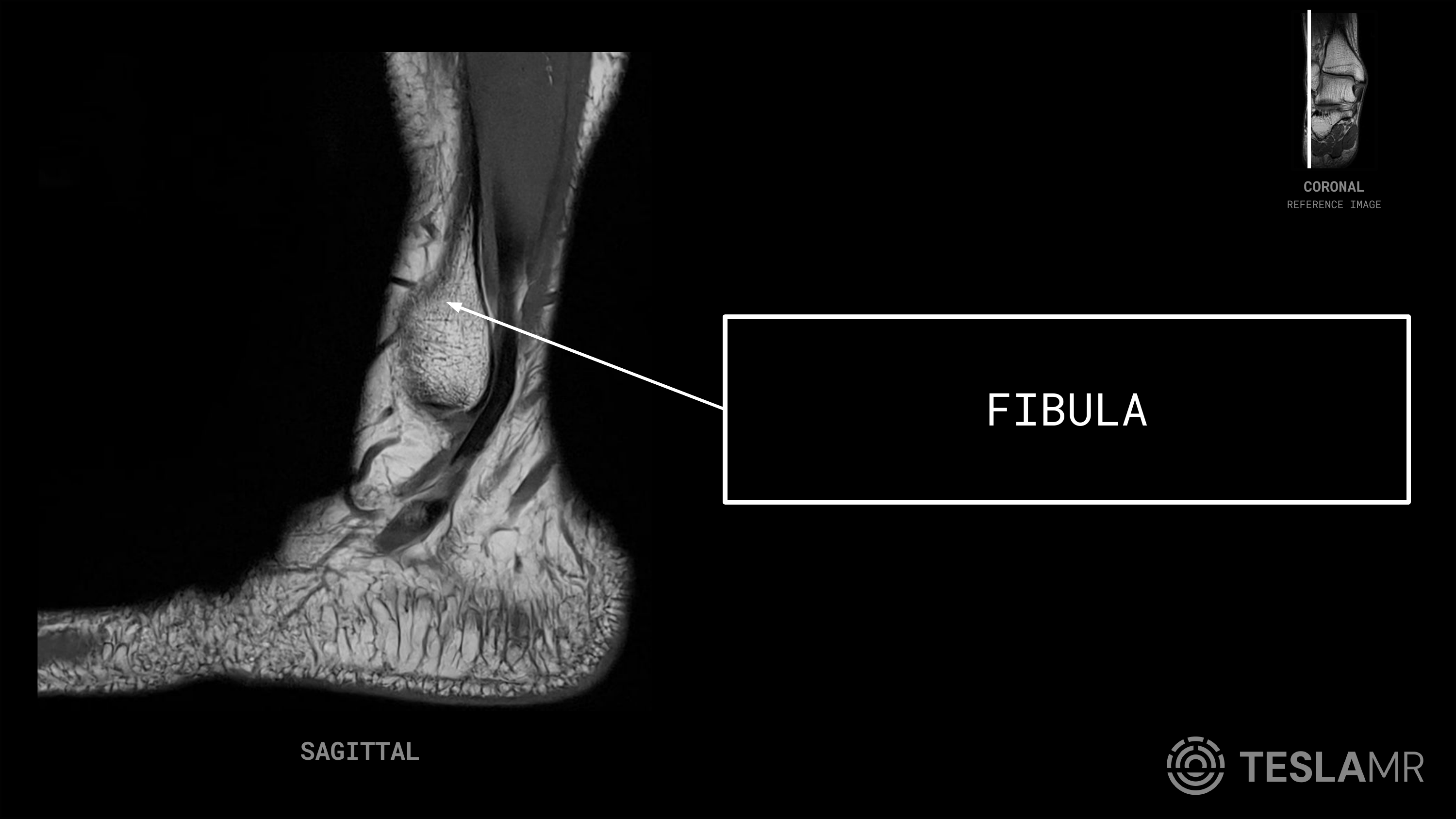 Fibula labeled on a Ankle MRI (Sagittal)
