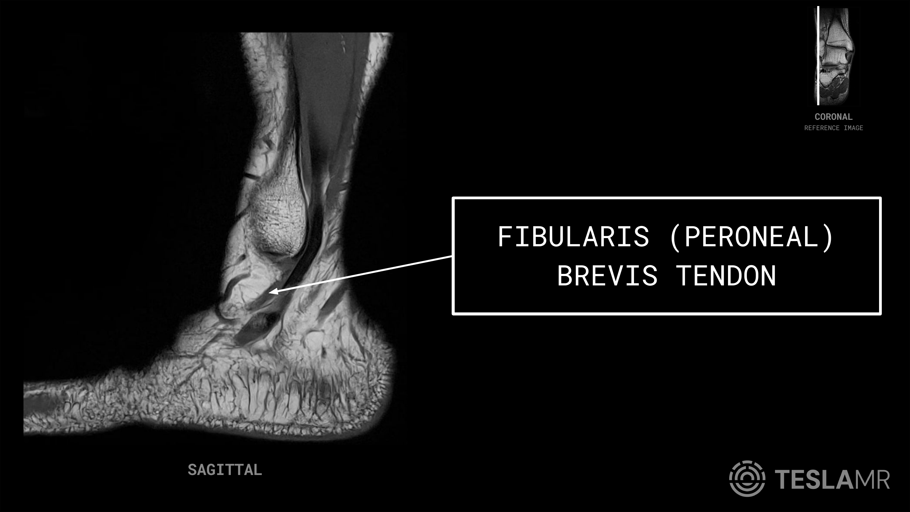 Fibularis (peroneal) Brevis Tendon labeled on a Ankle MRI (Sagittal · Coronal)