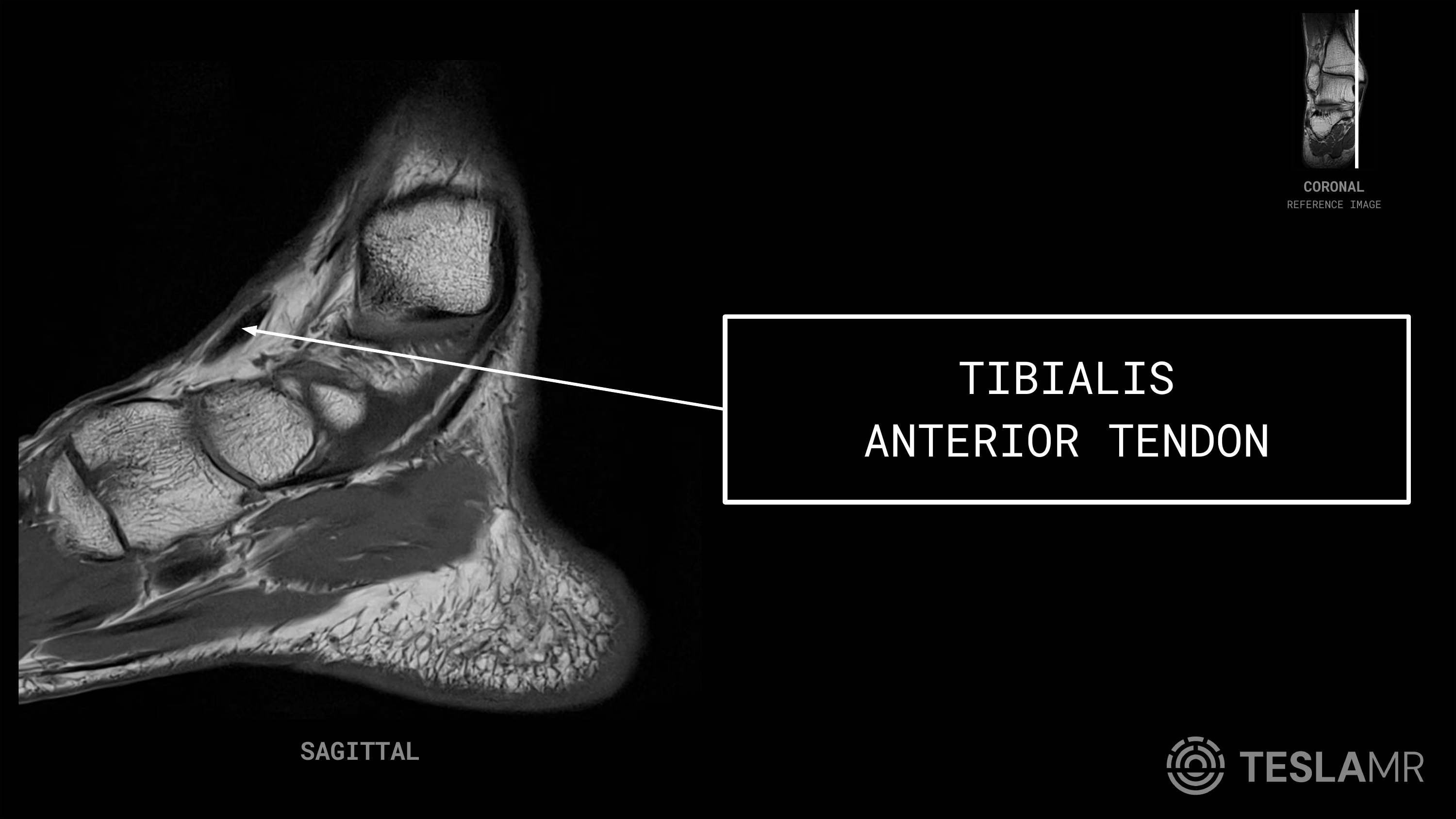 Tibialis Anterior Tendon labeled on a Ankle MRI (Sagittal)
