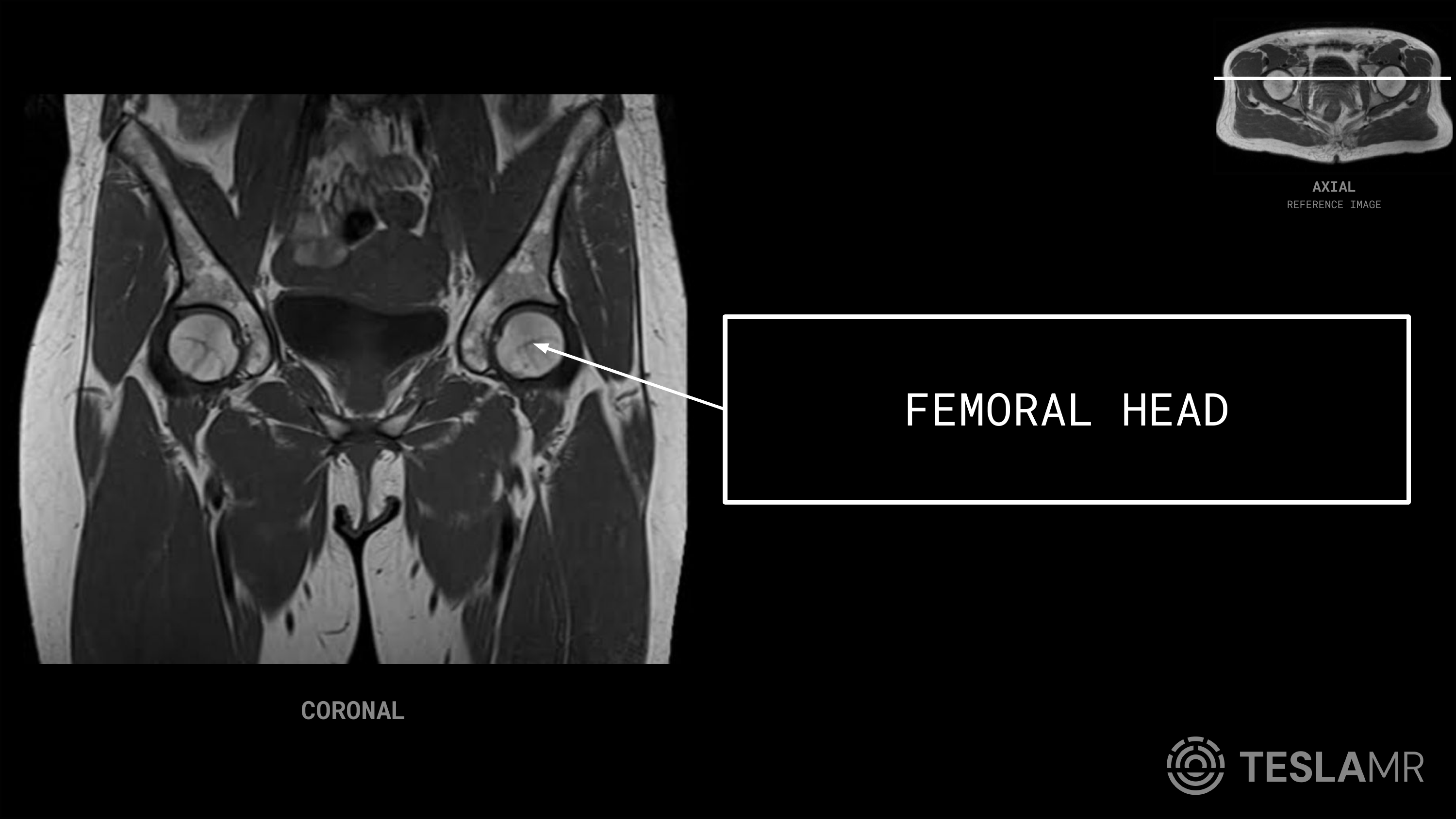 Femoral Head labeled on a Bony Pelvis MRI (Coronal)