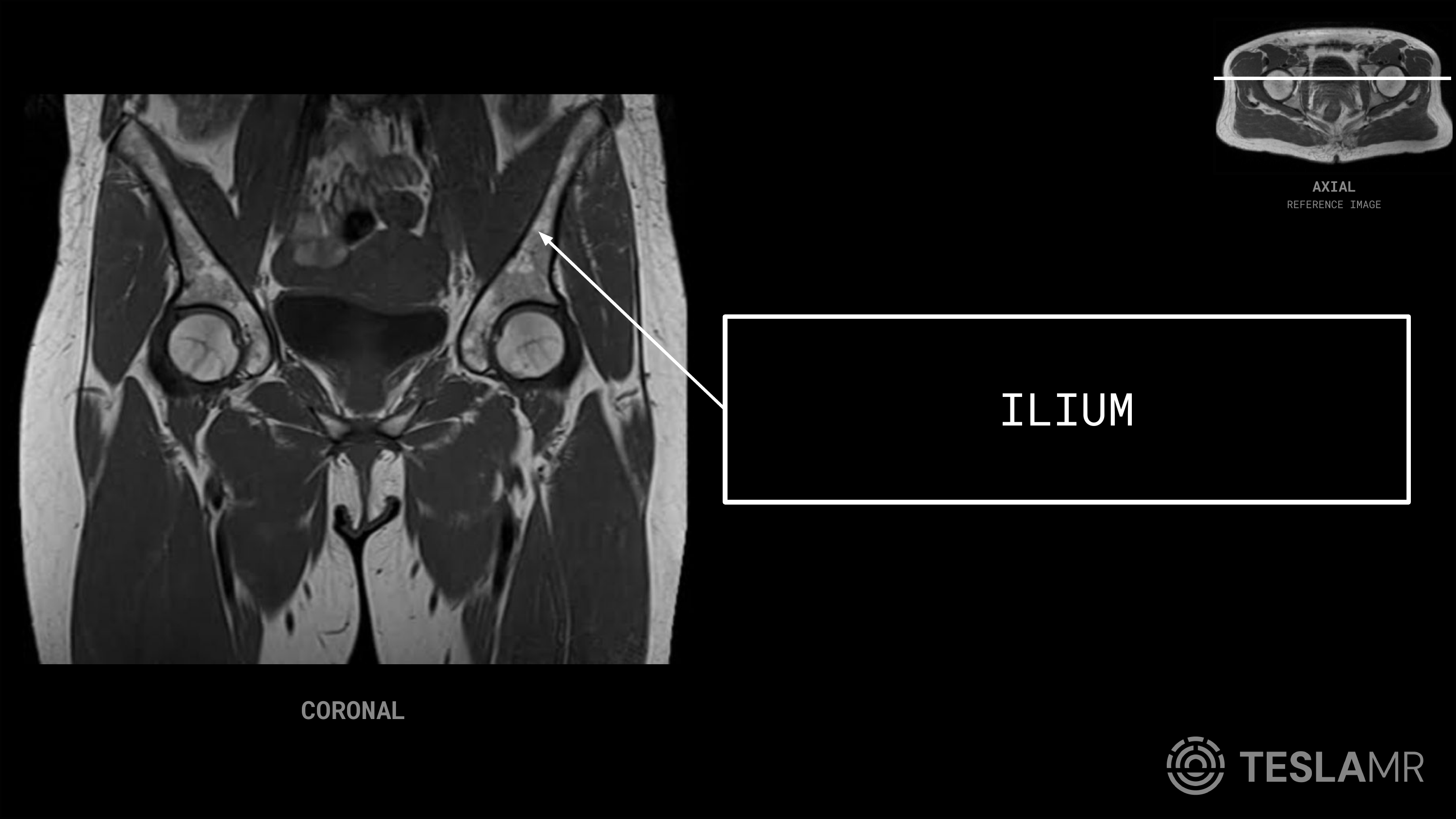 Ilium labeled on a Bony Pelvis MRI (Coronal)