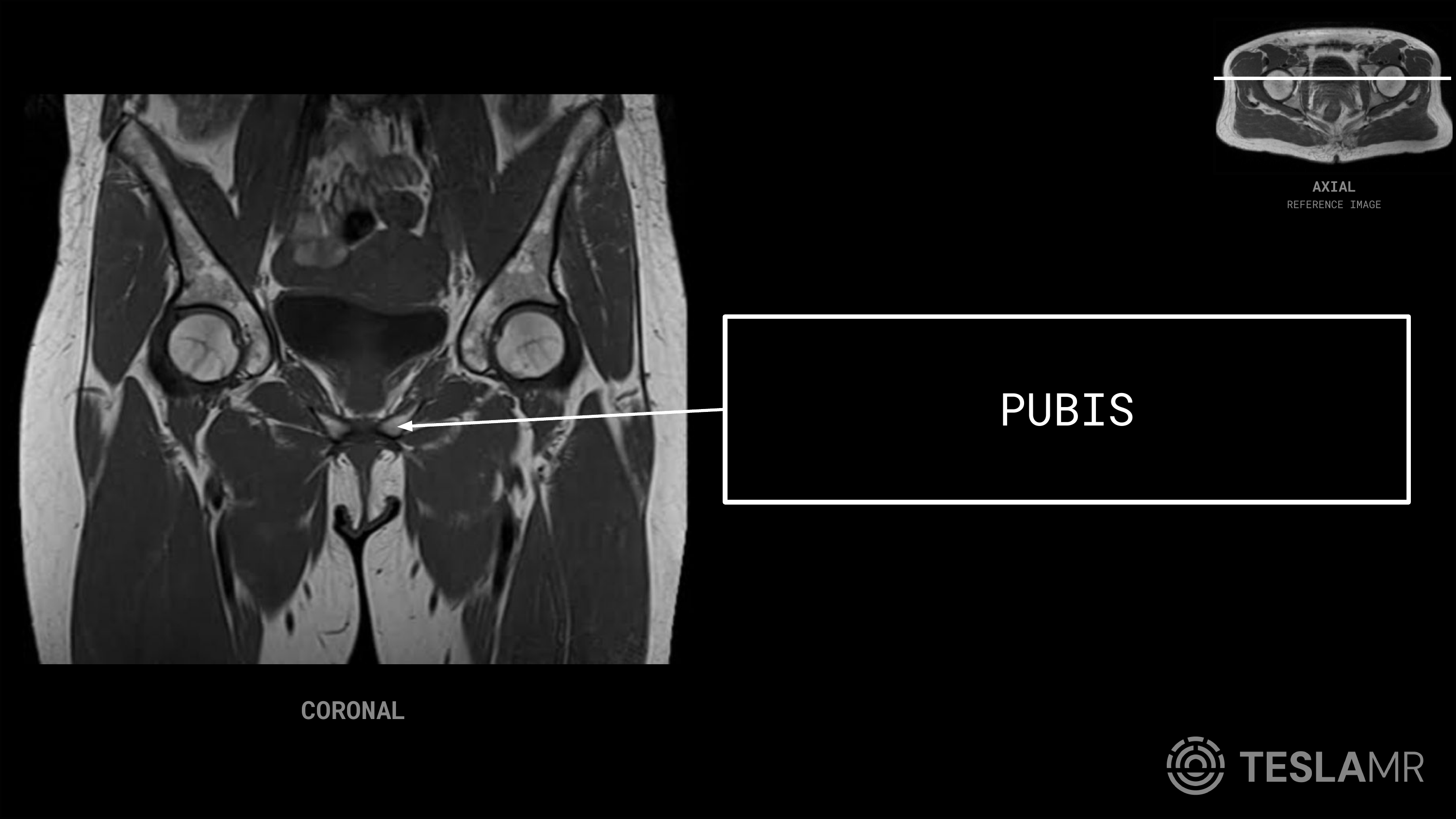 Pubis labeled on a Bony Pelvis MRI (Coronal)