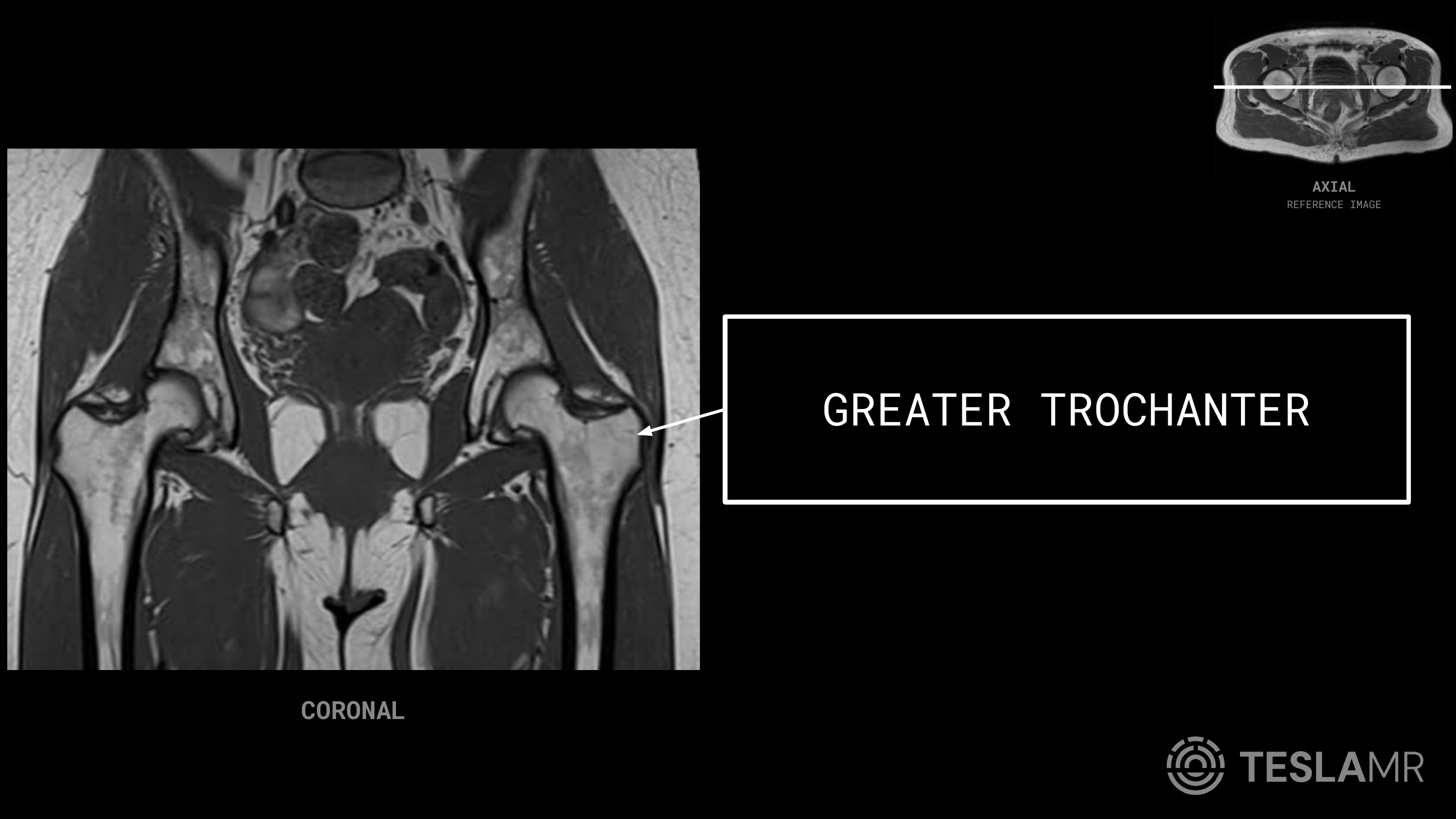 Greater Trochanter labeled on a Bony Pelvis MRI (Coronal)