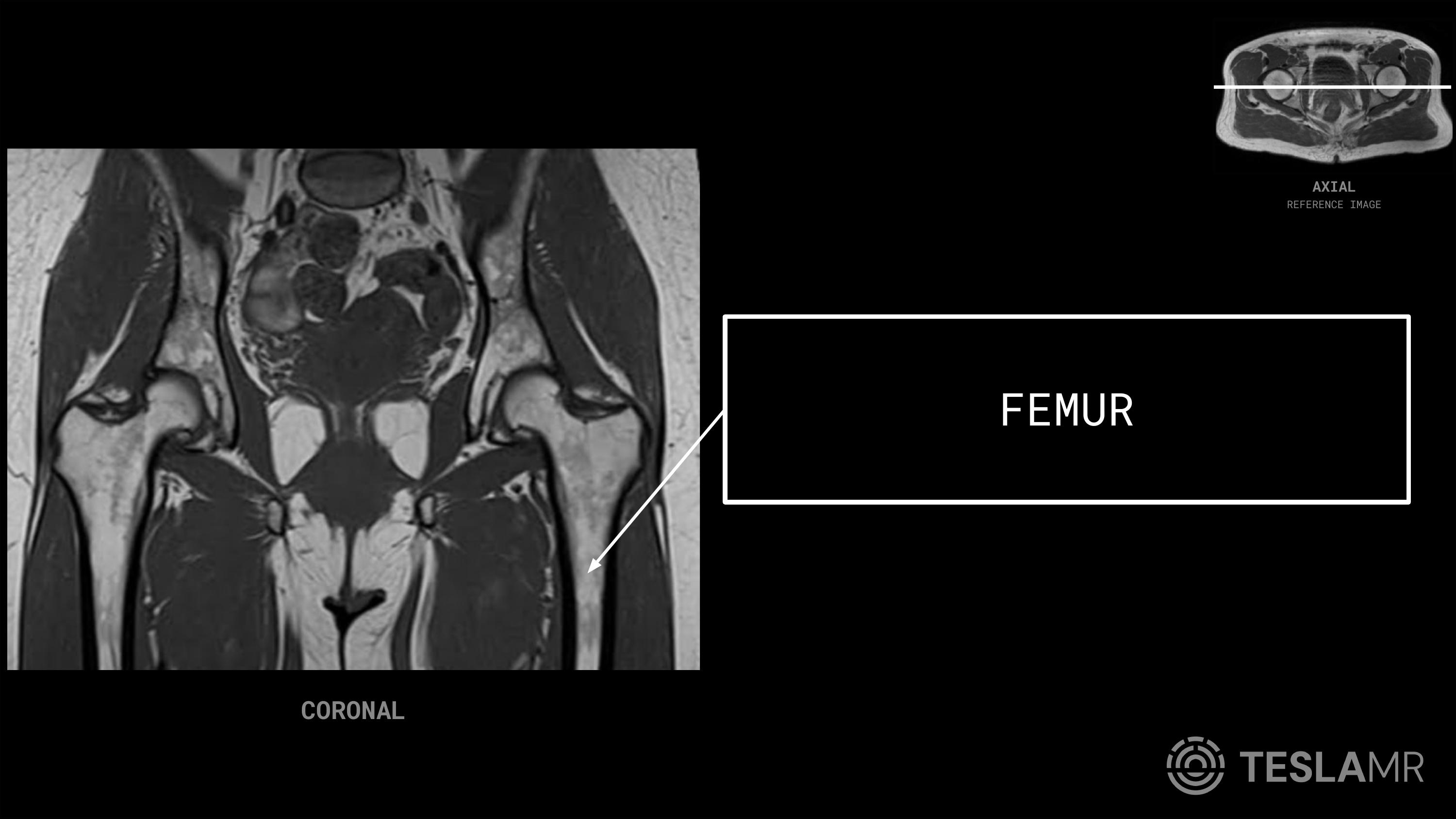 Femur labeled on a Bony Pelvis MRI (Coronal)