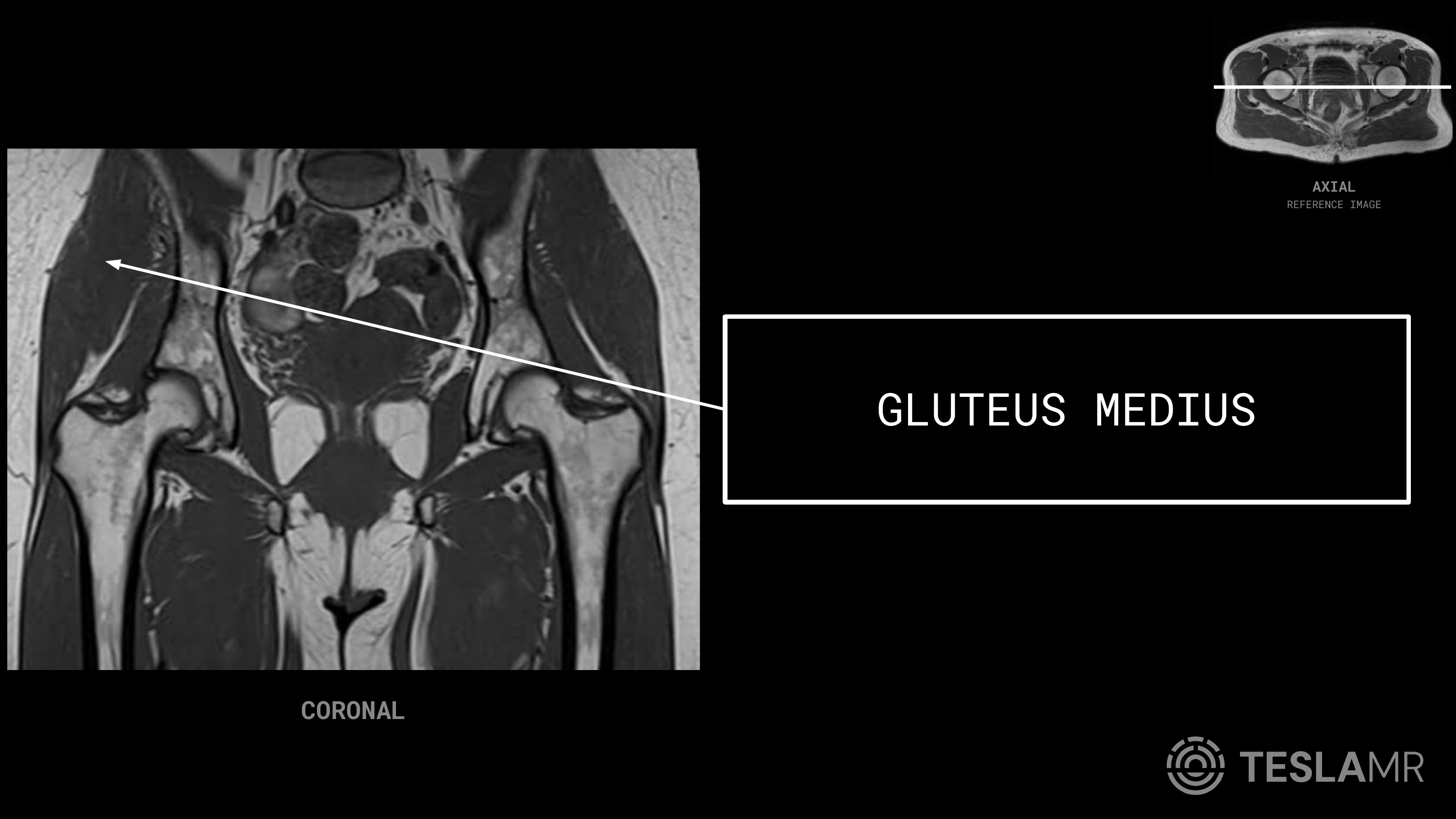 Gluteus Medius labeled on a Bony Pelvis MRI (Coronal)