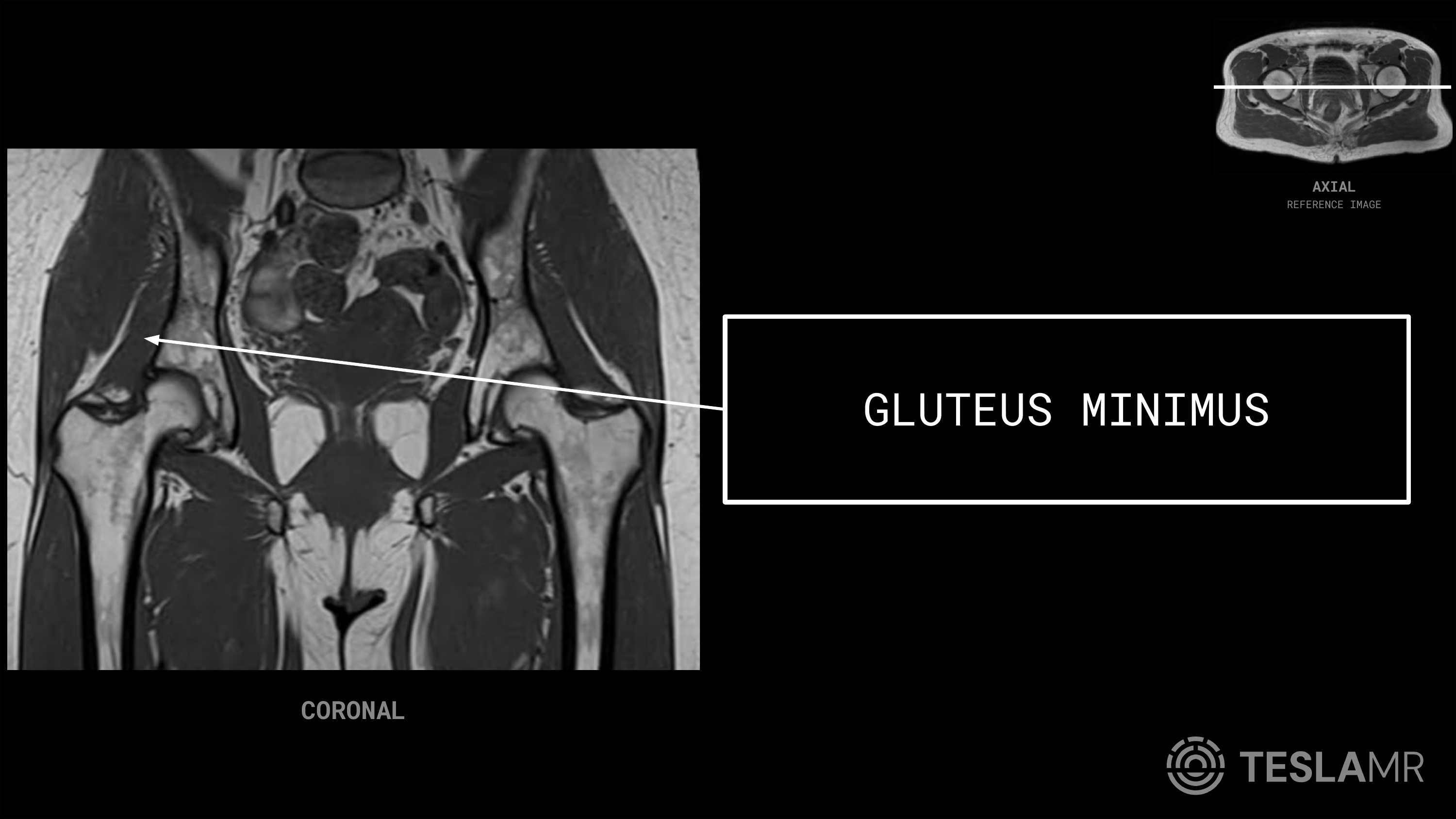 Gluteus Minimus labeled on a Bony Pelvis MRI (Coronal)