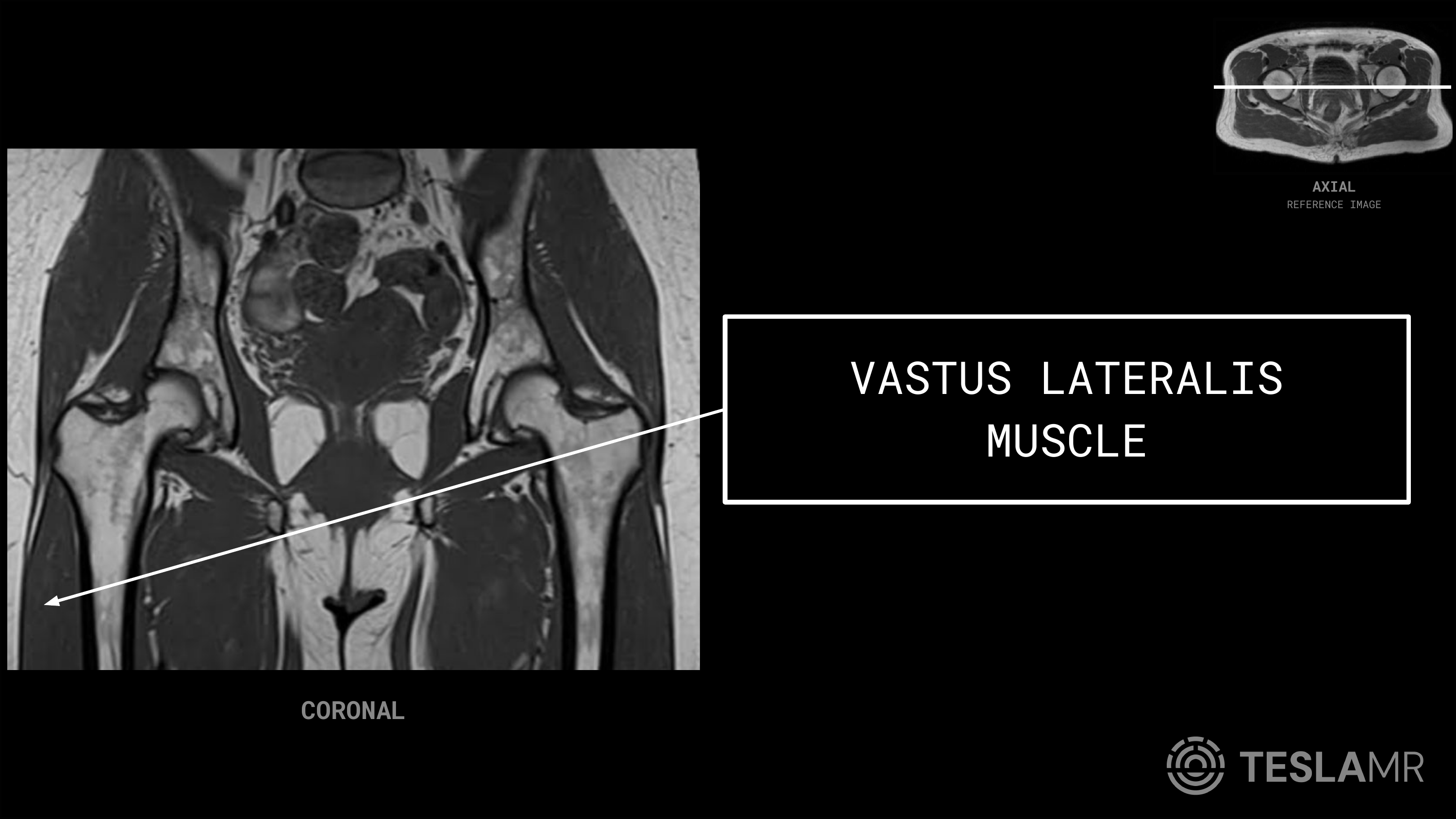Vastus Lateralis Muscle labeled on a Bony Pelvis MRI (Coronal)