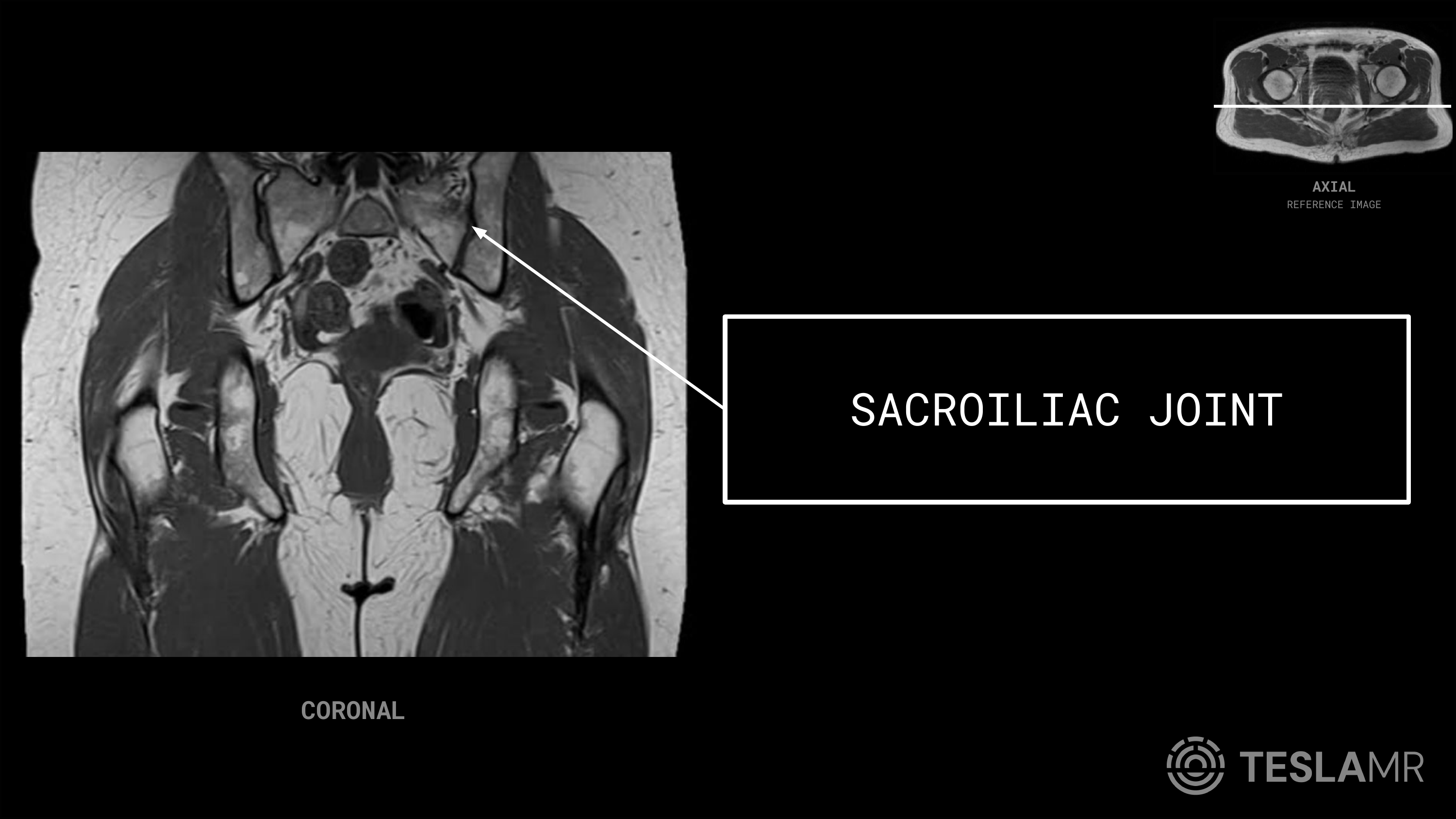 Sacroiliac Joint labeled on a Bony Pelvis MRI (Coronal)