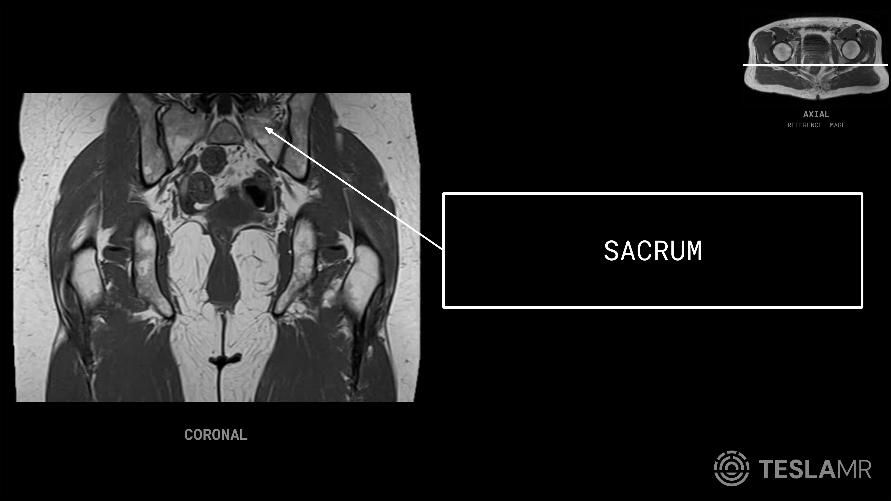 Sacrum labeled on a Bony Pelvis MRI (Coronal)