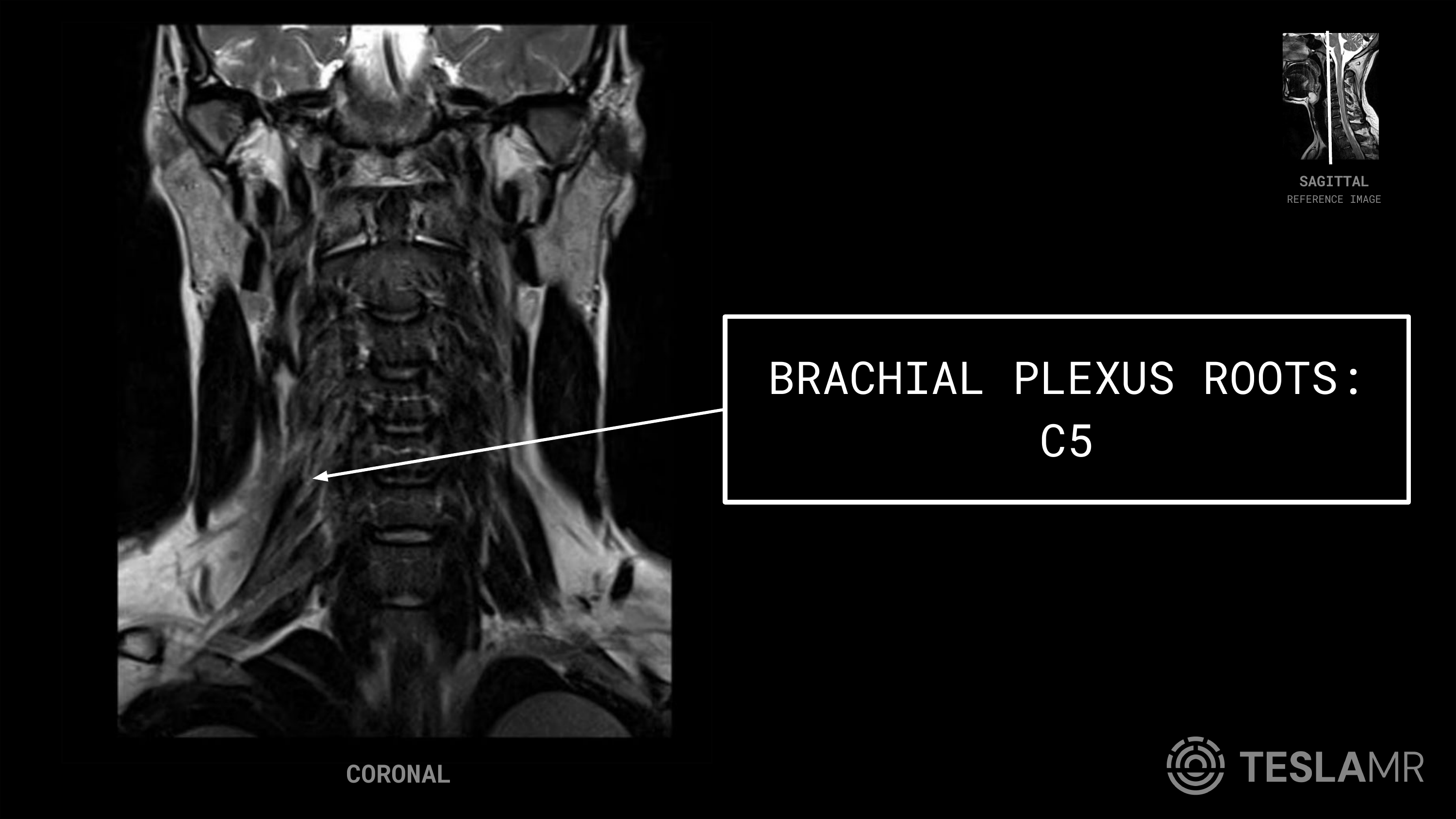 Brachial Plexus Roots: C5 labeled on a Brachial Plexus MRI (Coronal)