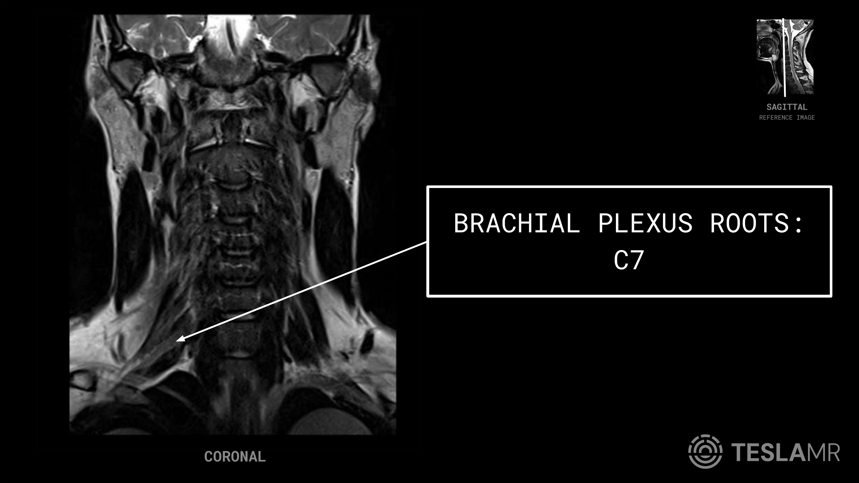 Brachial Plexus Roots: C7 labeled on a Brachial Plexus MRI (Coronal)