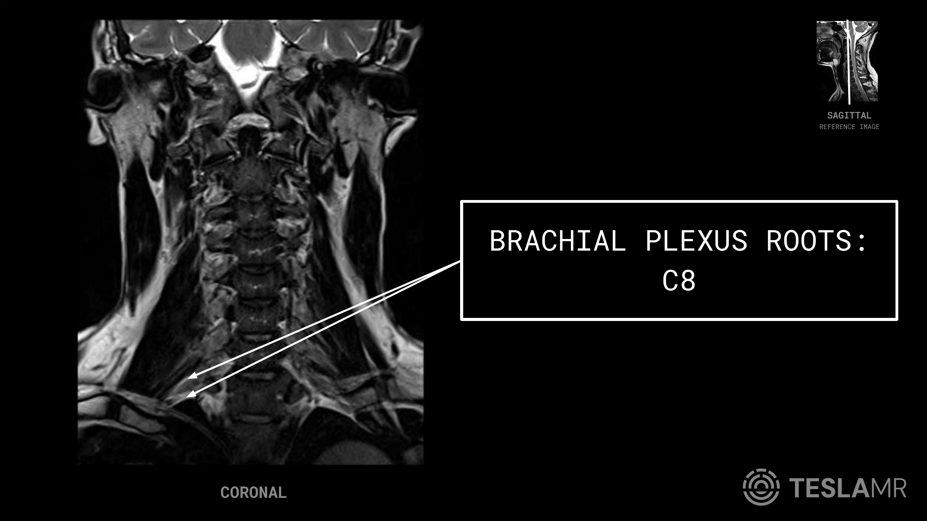 Brachial Plexus Roots: C8 labeled on a Brachial Plexus MRI (Coronal)
