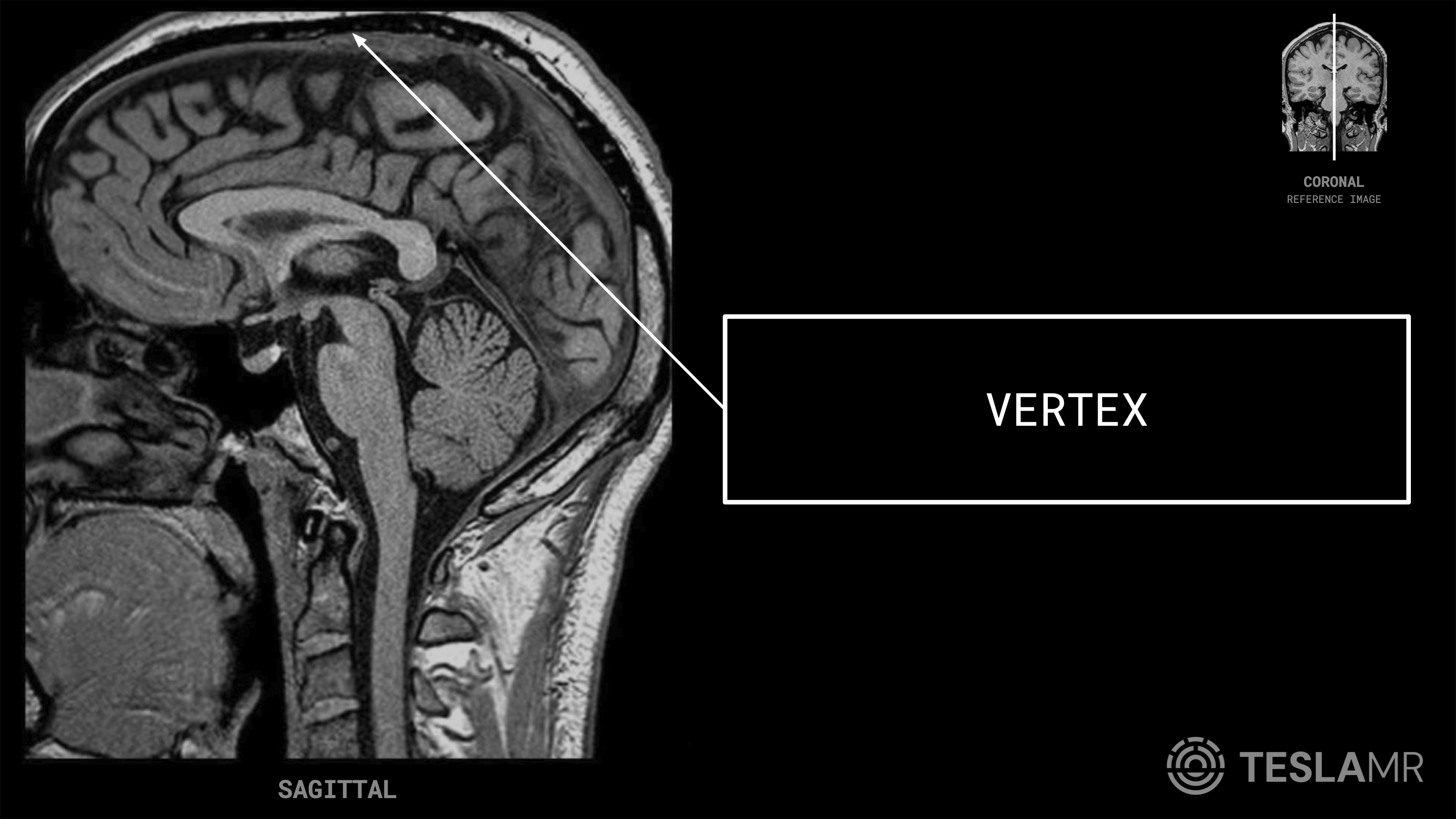 Vertex labeled on a Brain MRI (Sagittal · Coronal)