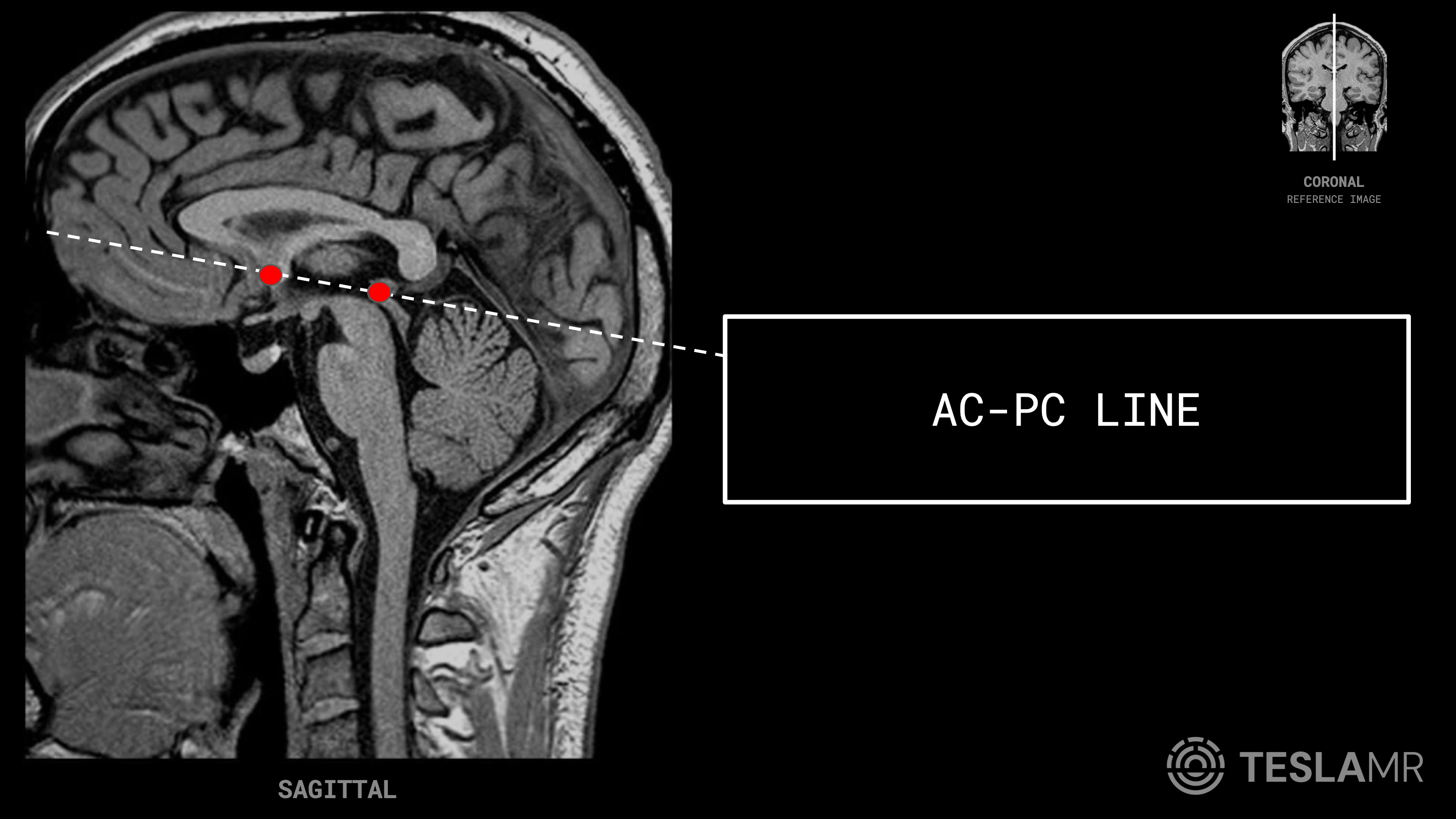 AC-PC Line labeled on a Brain MRI (Sagittal)