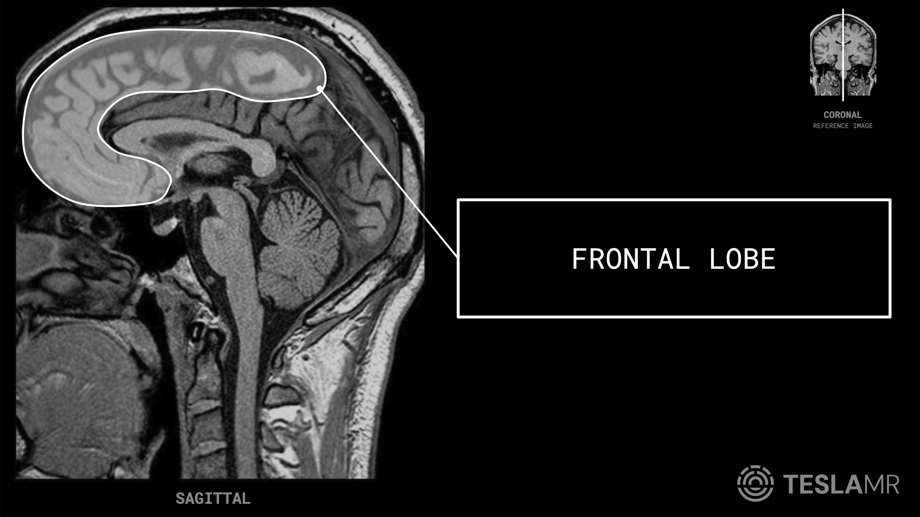 Frontal Lobe labeled on a Brain MRI (Sagittal · Coronal)
