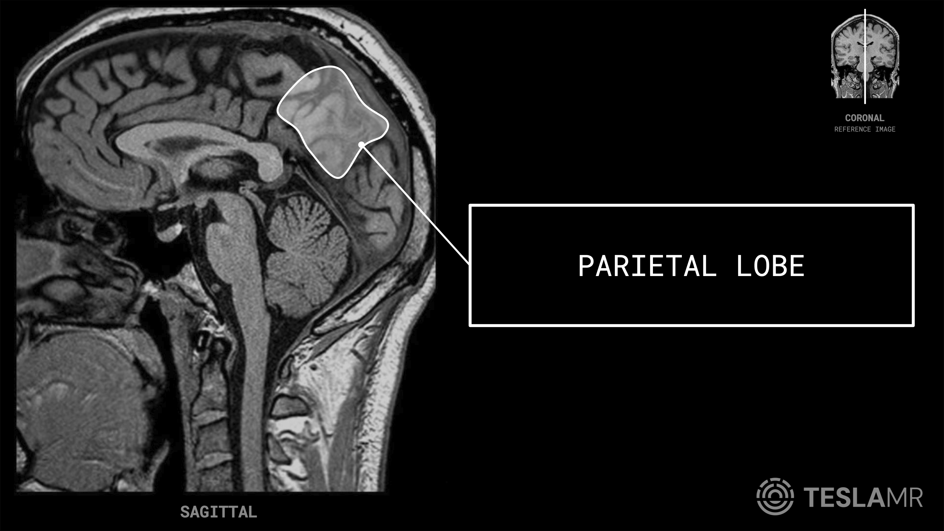 Parietal Lobe labeled on a Brain MRI (Sagittal · Coronal)