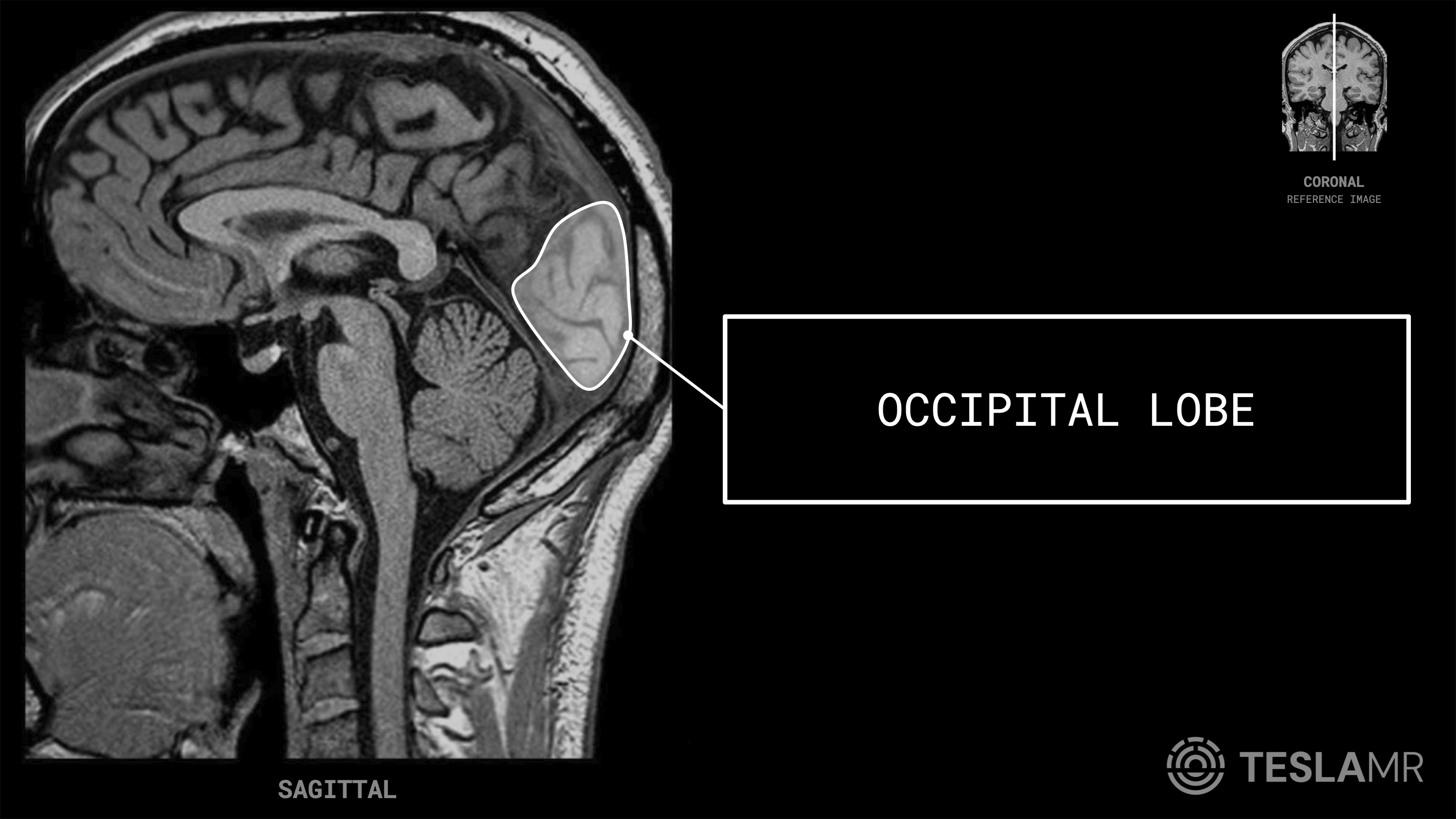 Occipital Lobe labeled on a Brain MRI (Sagittal)