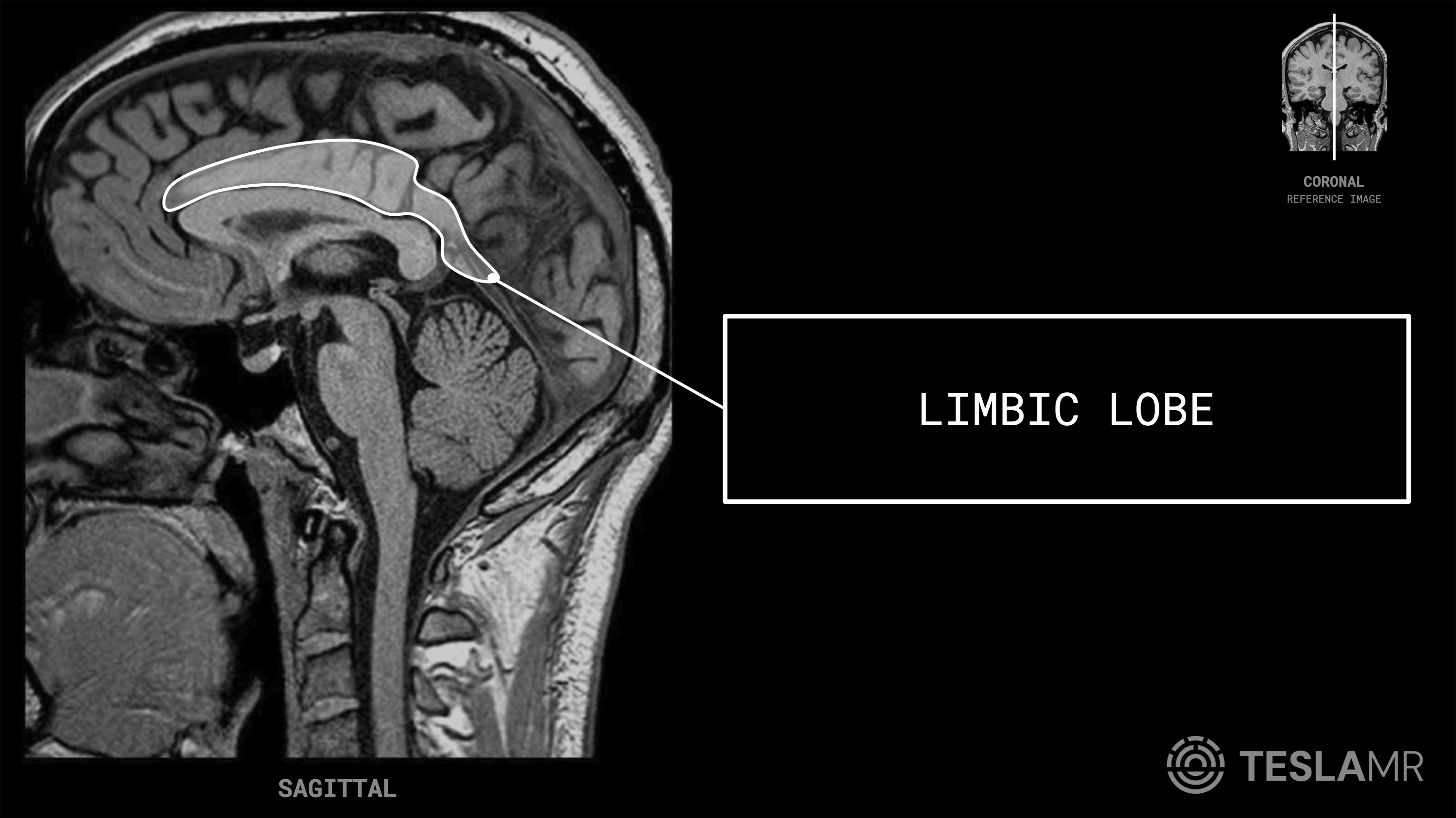 Limbic Lobe labeled on a Brain MRI (Sagittal · Coronal)